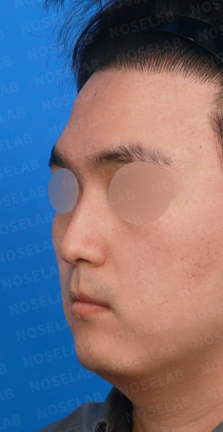 비중격이 휘면 코막힘과 휜 코가 함께 생기는 이유, 재건은 어떻게 하나 — 디자인 상담 정면, 좌측 측면, 비스듬한 측면 사진입니다.