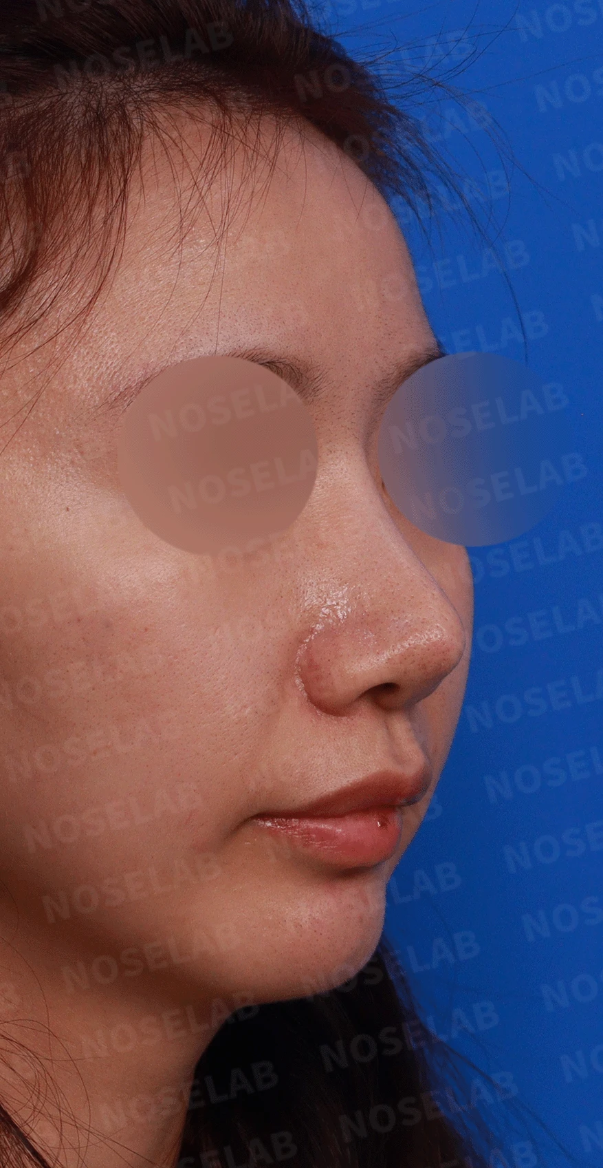 코끝 고어텍스가 문제를 일으키는 이유와 늑연골 비중격 재건 방법 — 디자인 상담 우측 측면, 비스듬한 측면, 비공 사진입니다.