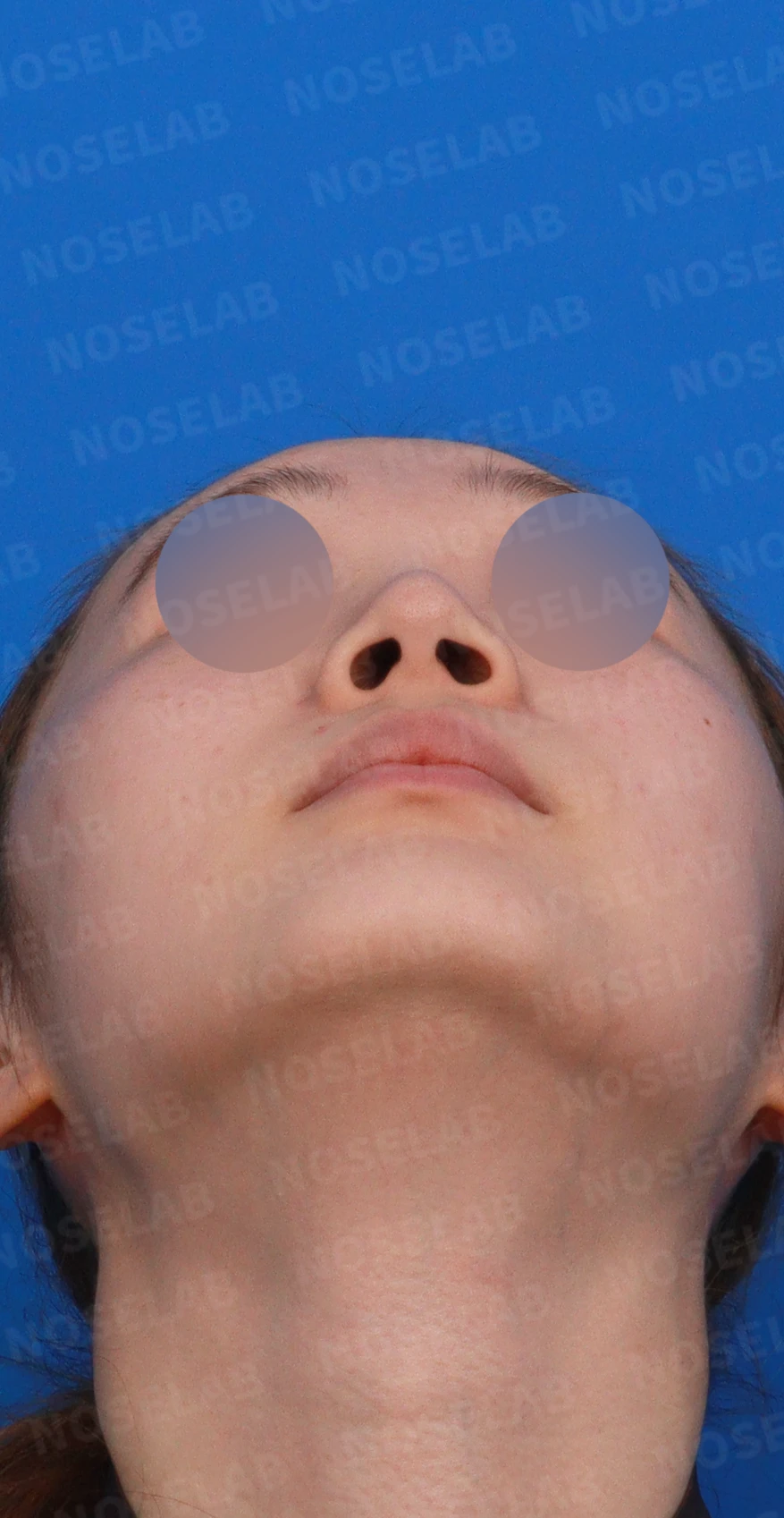 퍼진 코끝에 코막힘이 함께 오는 이유, 이물질 제거와 재건은 어떻게 하나 — 디자인 상담 우측 측면, 비스듬한 측면, 비공 사진입니다.