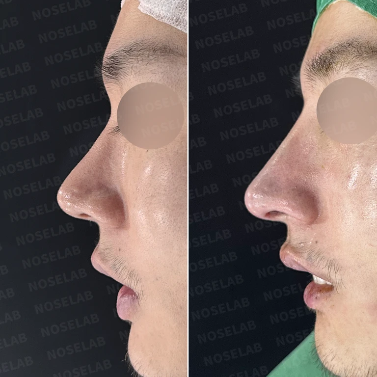 짧고 들린 코, 자가늑연골로 남성적인 라인으로 완성한 코재수술 — 전후 비교