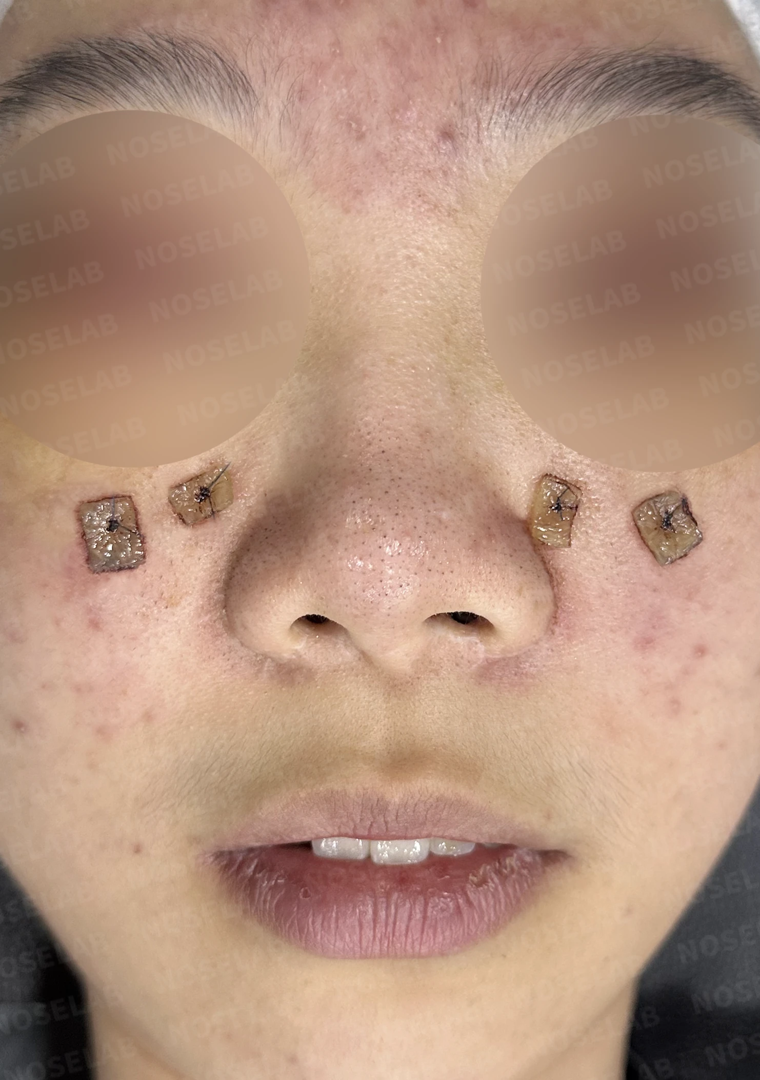 메드포어로 손상된 비중격, 자가늑연골로 완벽하게 재건하다 — 전(좌) 직후(후)