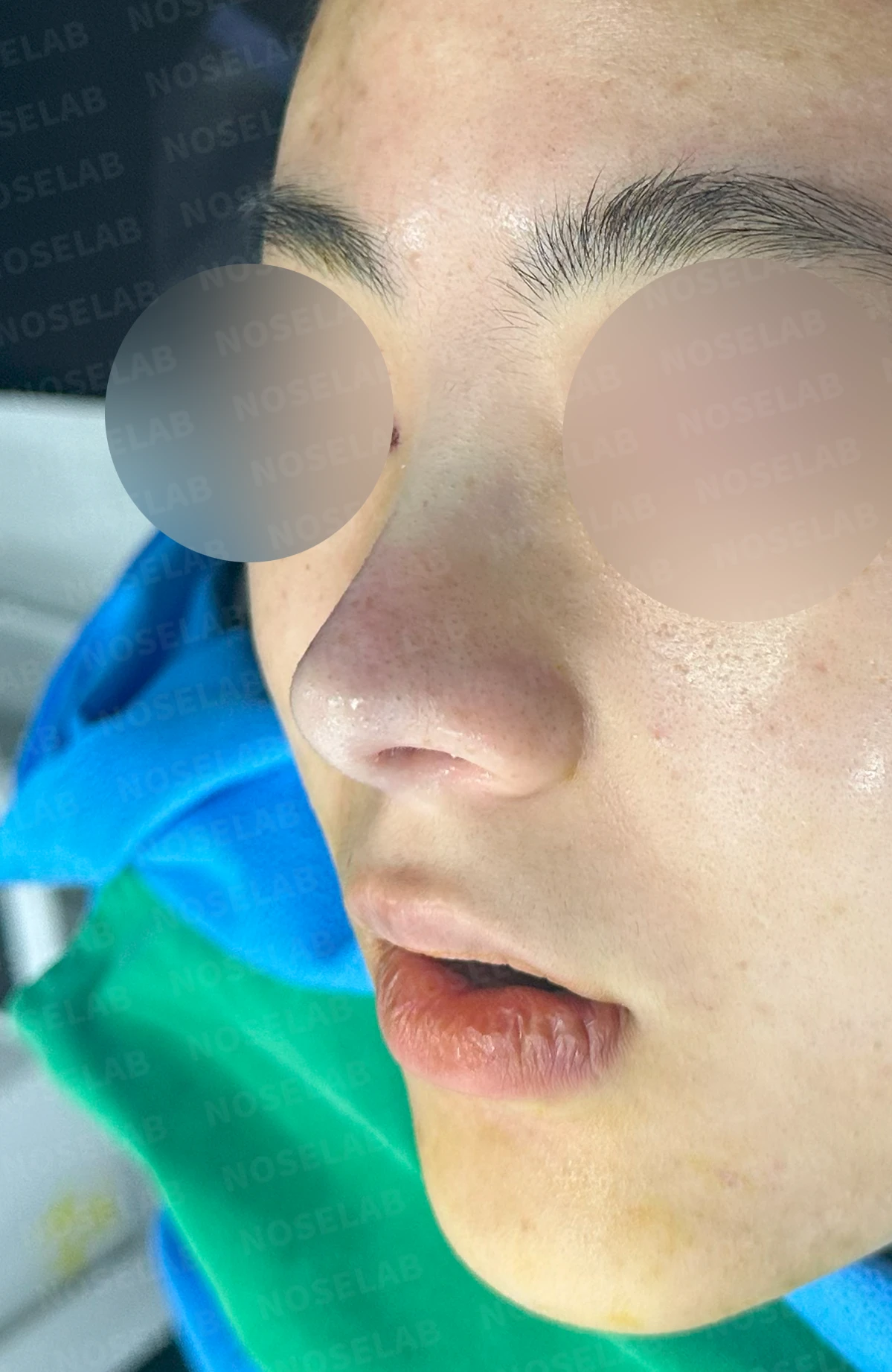 코끝 피부가 두껍고 잘 늘어나지 않는 코에서 높이와 직반 라인을 만드는 방법 — 수술 직후 0일 정면, 측면, 비스듬한 측면 사진 직후 사진은 부기가 있는 상태로 최종 결과와 다를 수 있습니다.
