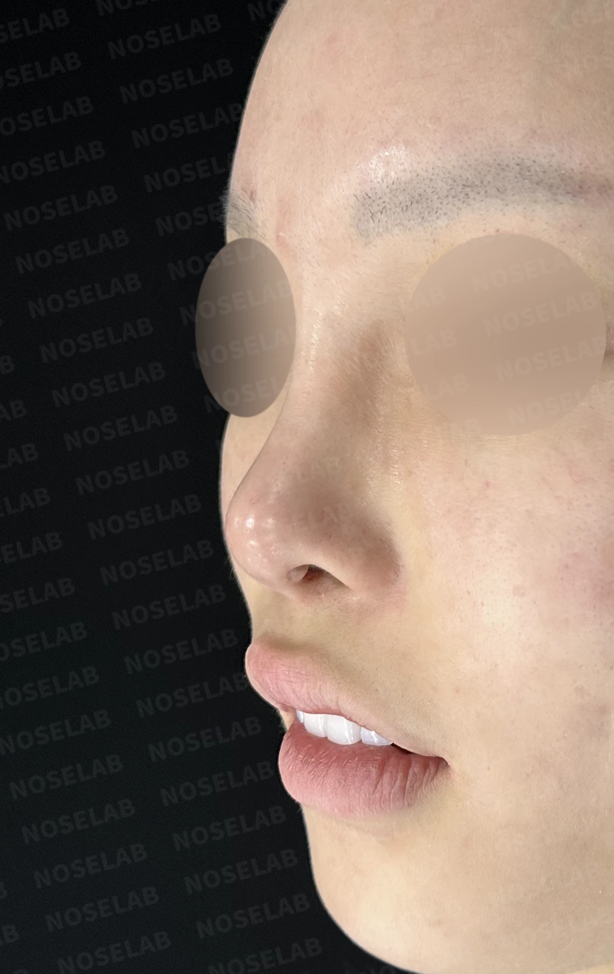 심한 비중격 만곡과 높은 콧대 시작점, 기증늑연골로 정밀 재건 — 직후 정면, 비스듬한 측면, 측면 사진입니다.