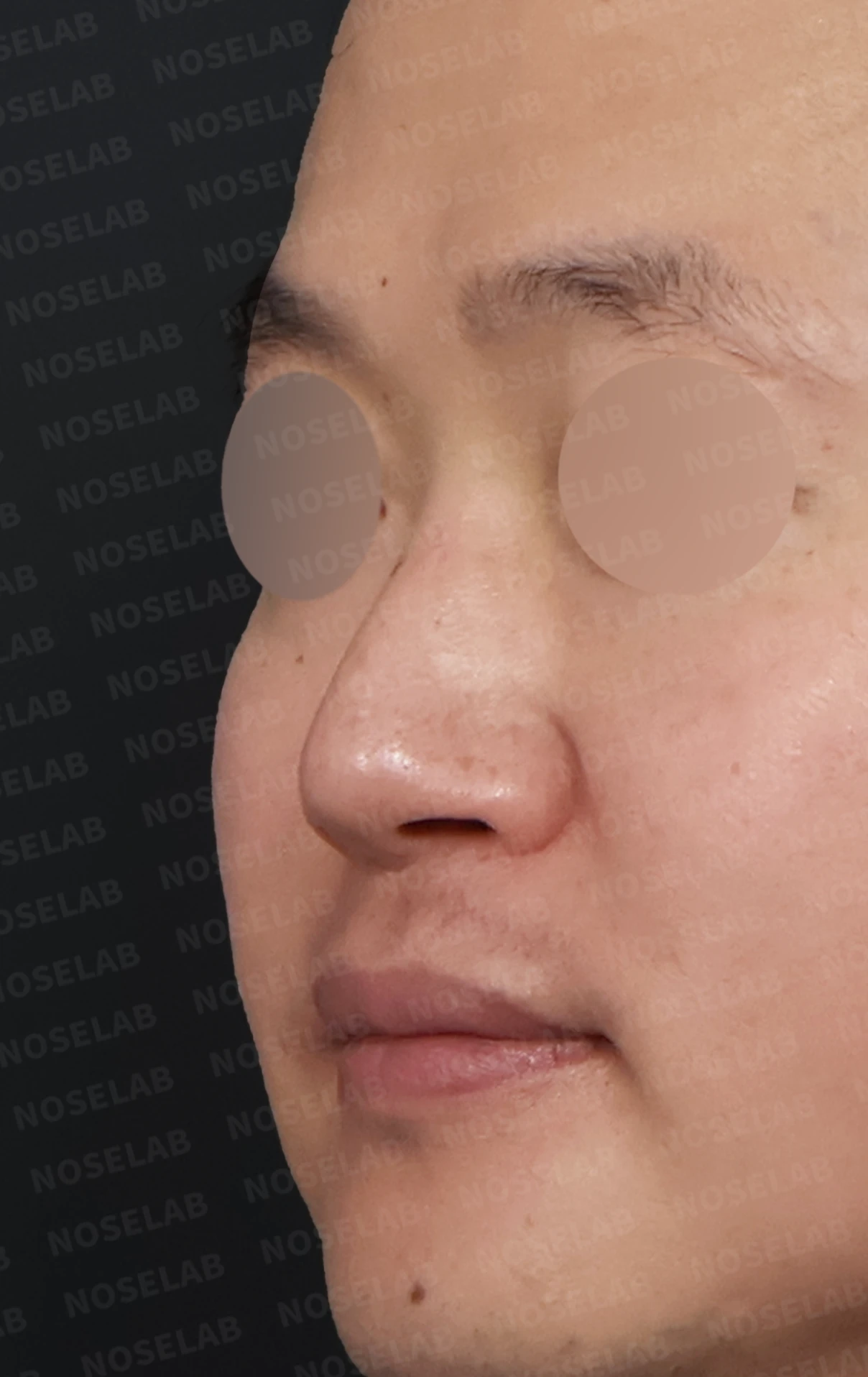 코막힘과 휘어진 비중격, 자가늑연골로 기능과 모양을 동시에 개선 — 전(좌) 직후(후)