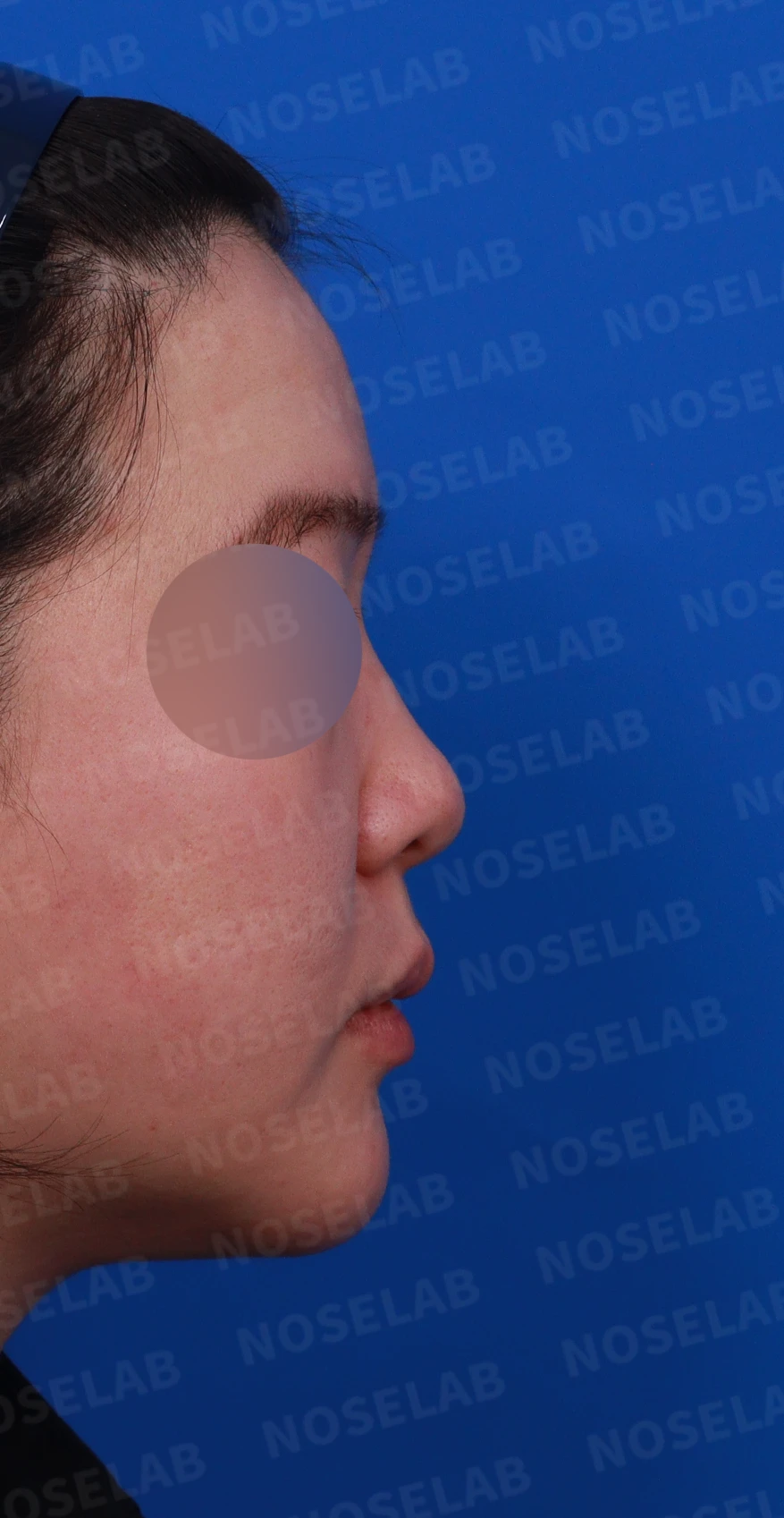 코끝이 퍼지고 입체감이 없어 보이는 이유, 복코 교정은 어떻게 하나 — 디자인 상담 우측 측면, 비스듬한 측면 사진, 비공 사진