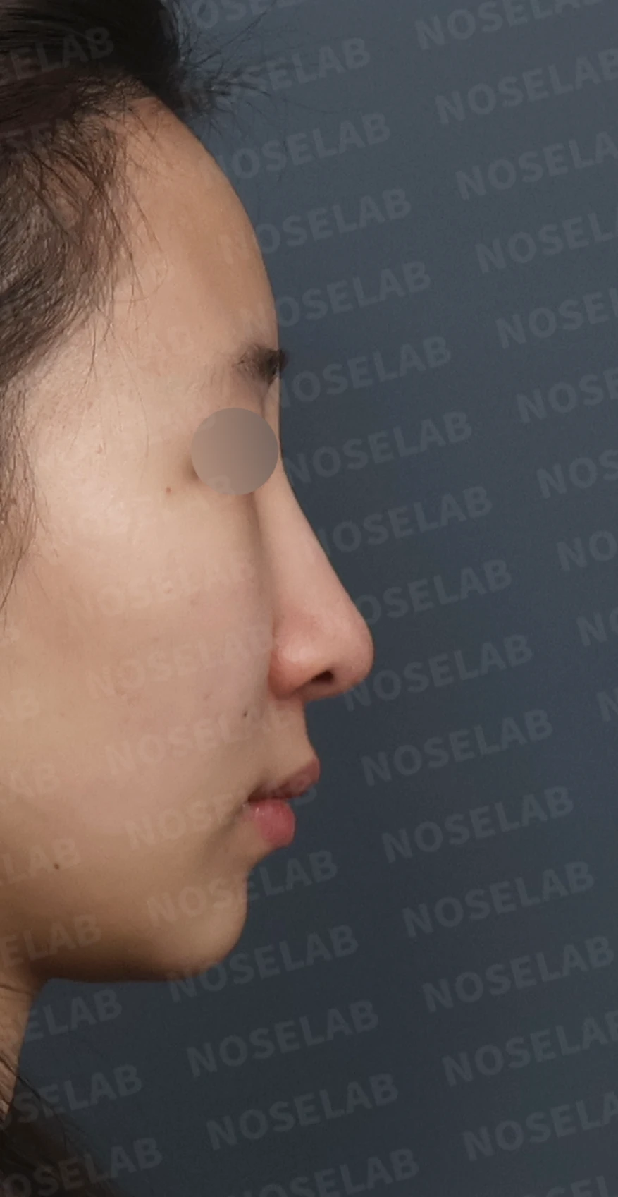 길고 처진 코, 휜코 교정과 코막힘까지 한 번에 해결한 재수술 사례 — 디자인 상담 우측 측면, 비스듬한 측면, 비공 사진입니다.