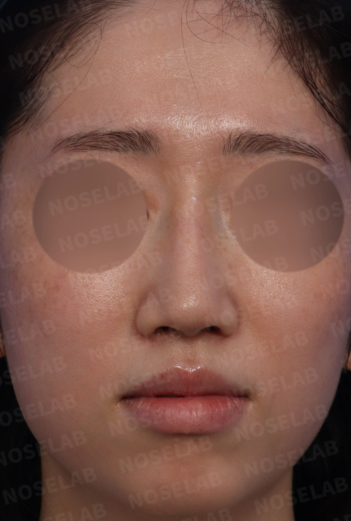 이물질(메쉬·실) 제거후 코성형 방법 — 본문 사진 1