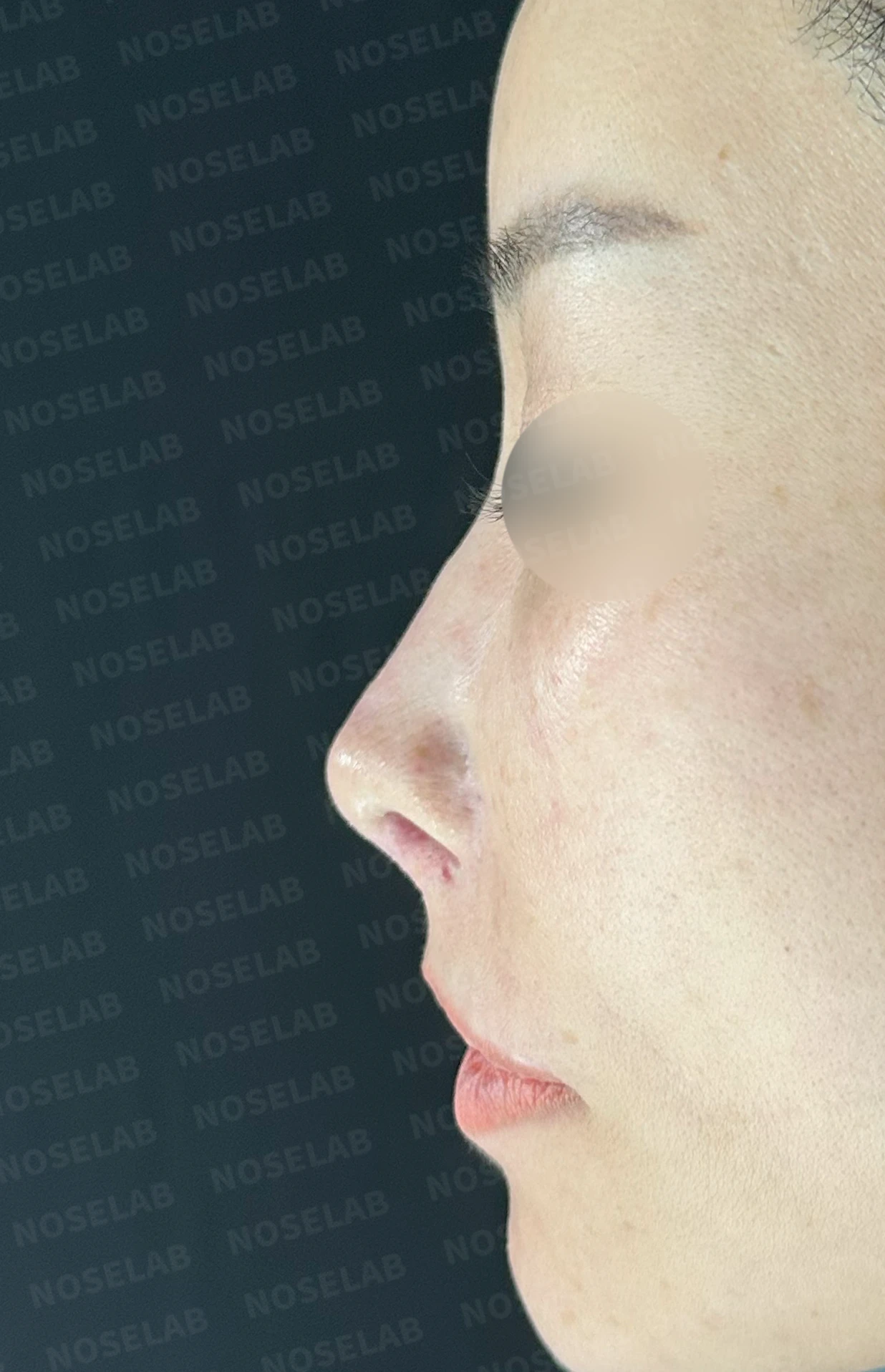 두꺼운 비주와 들린 코끝이 생기는 이유, 자가 늑연골 재건은 어떻게 하나 — 수술 전 / 수술 직후 0일 직후 사진은 부기가 있는 상태로 최종 결과와 다를 수 있습니다.