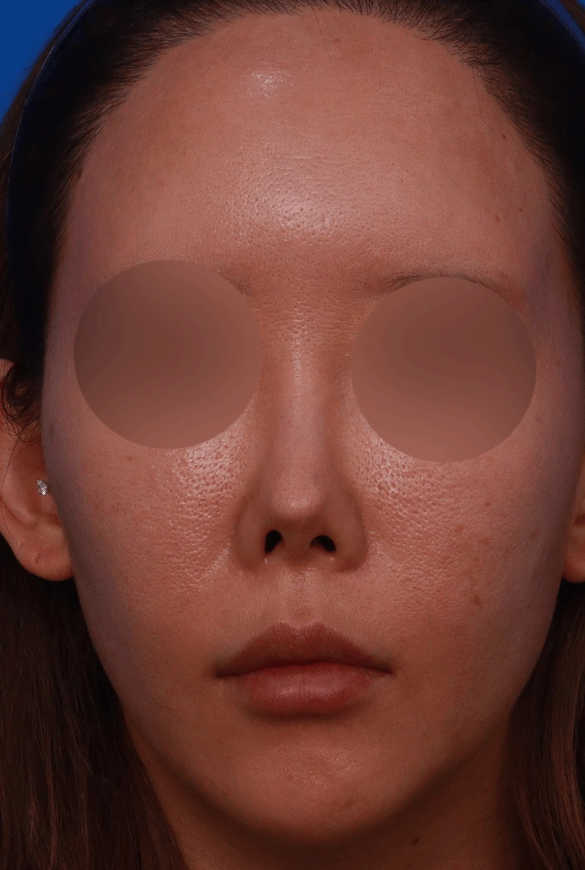 얇은 코끝 피부와 들린코 개선 - 복합 코 재수술 사례 — 디자인 상담 정면 , 좌측 측면 ,비스듬한 측면 사진