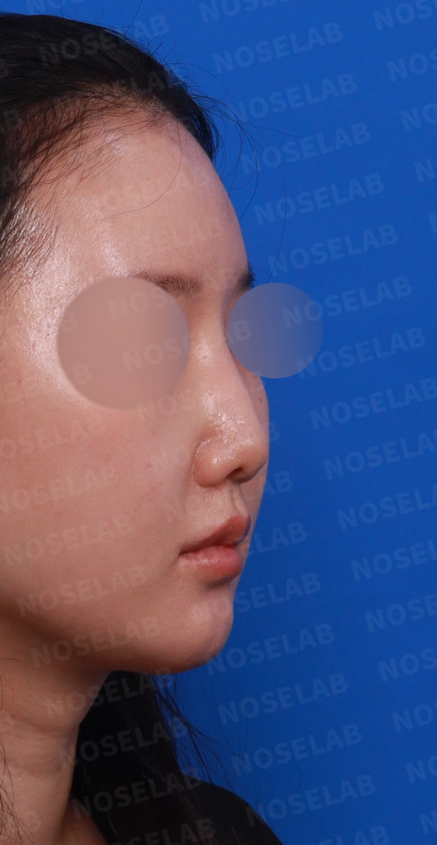 비공 비대칭과 코끝 처짐은 왜 생기나, 연골을 병용한 재건 방법 — 디자인 상담 우측 측면, 비스듬한 측면, 비공 사진