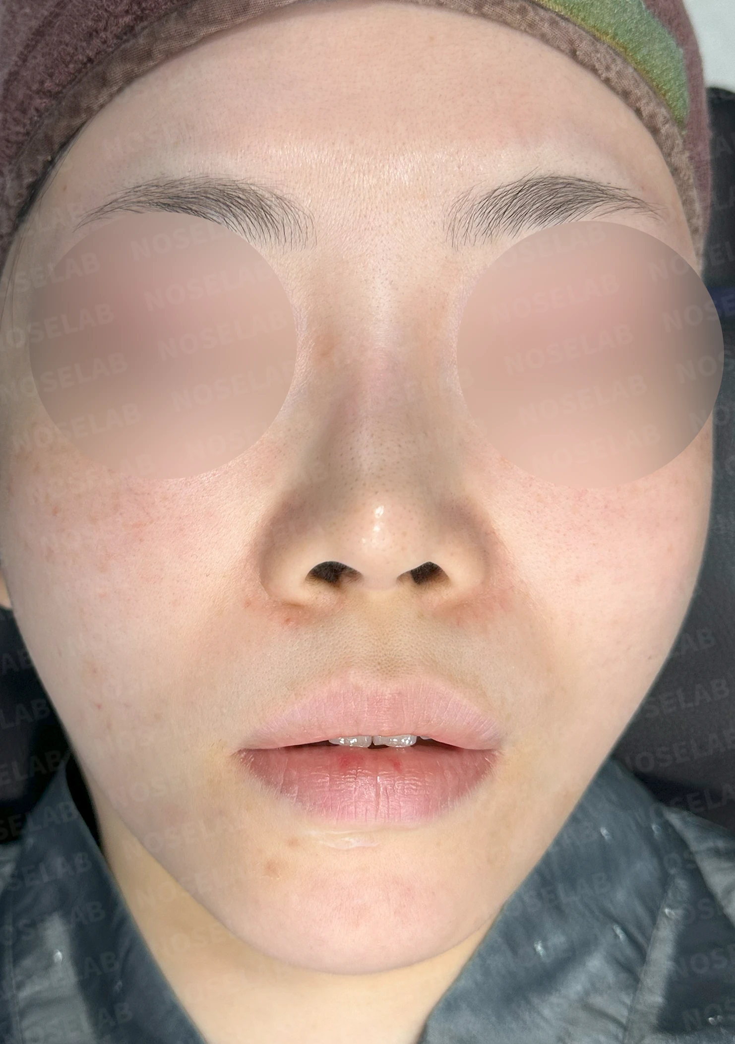 비중격 연골을 과도하게 채취하면 생기는 문제와 재건 방법 — 수술 전 / 수술 직후 0일 직후 사진은 부기가 있는 상태로 최종 결과와 다를 수 있습니다.