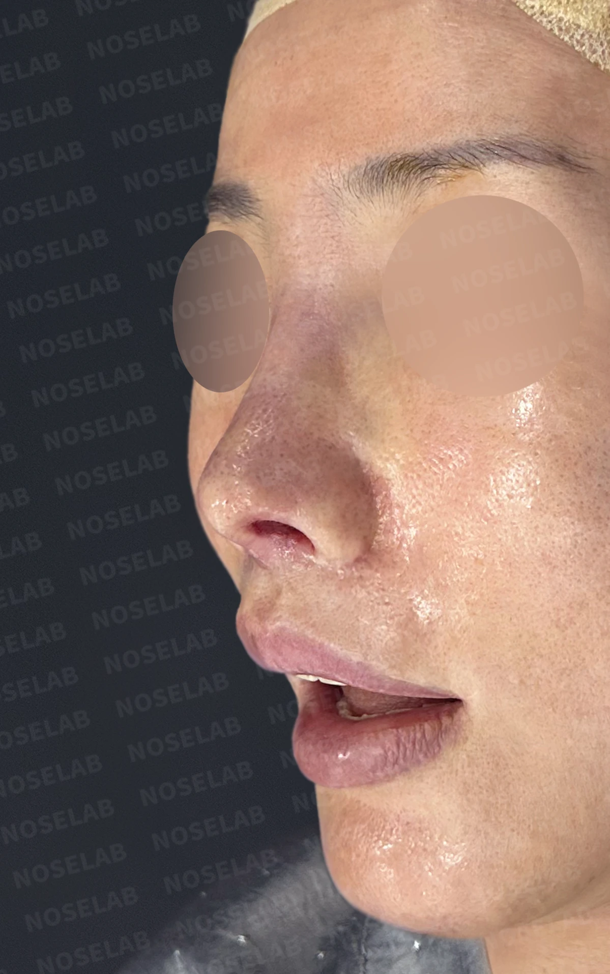 여러 차례 수술 뒤 비중격이 손상되면, 늑연골 재건은 어떻게 하나 — 수술 직후 0일 정면, 비스듬한 측면, 측면 사진입니다. 직후 사진은 부기가 있는 상태로 최종 결과와 다를 수 있습니다.