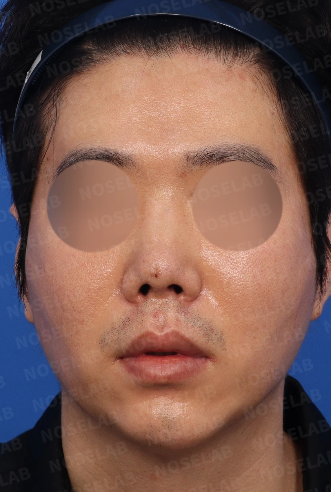 코끝 염증을 겪은 뒤 콧날개가 찝히고 코끝이 꺼지는 이유와 재건 방법 — 디자인 상담 정면, 좌측 측면, 비스듬한 측면 사진