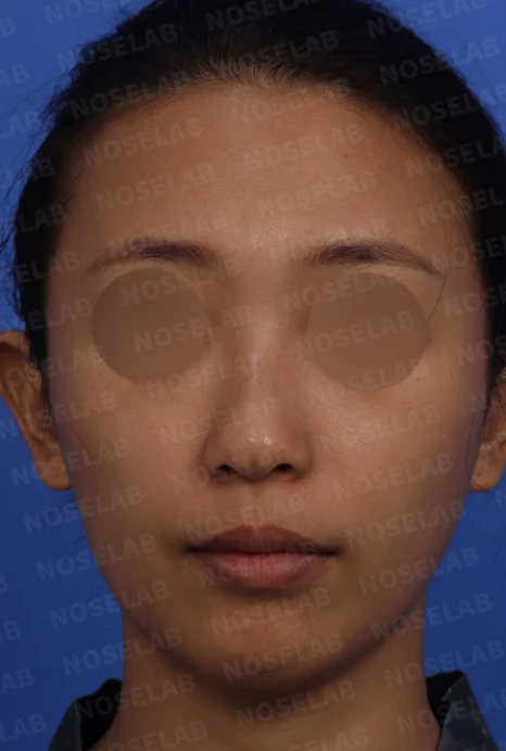 갈라져 보이는 코끝의 구조와 교정 방법 — 본문 사진 1