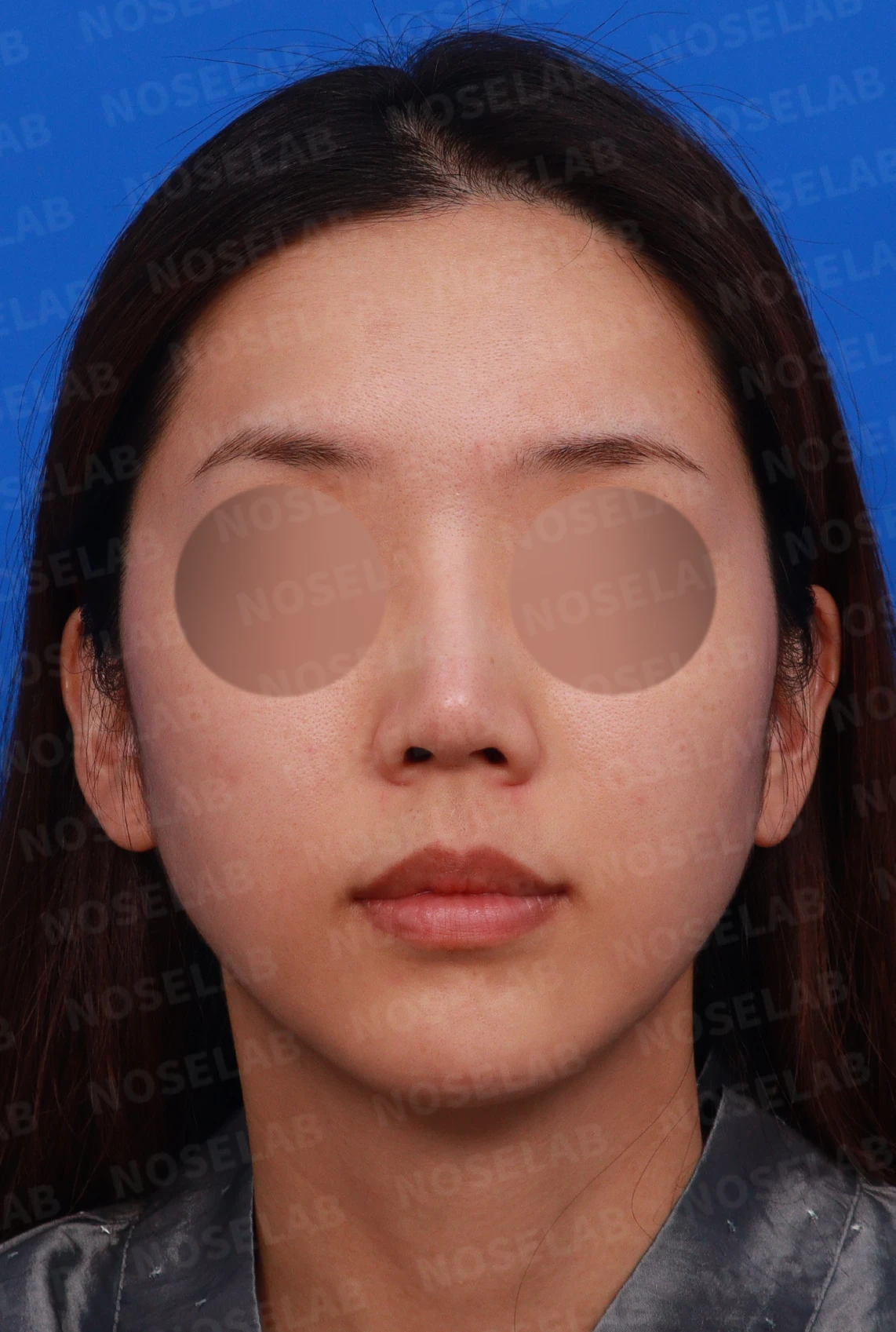 실리콘 부작용 후 자가늑연골로 재건하는 방법 — 디자인 상담 정면, 좌측 비스듬한 측면, 측면 사진