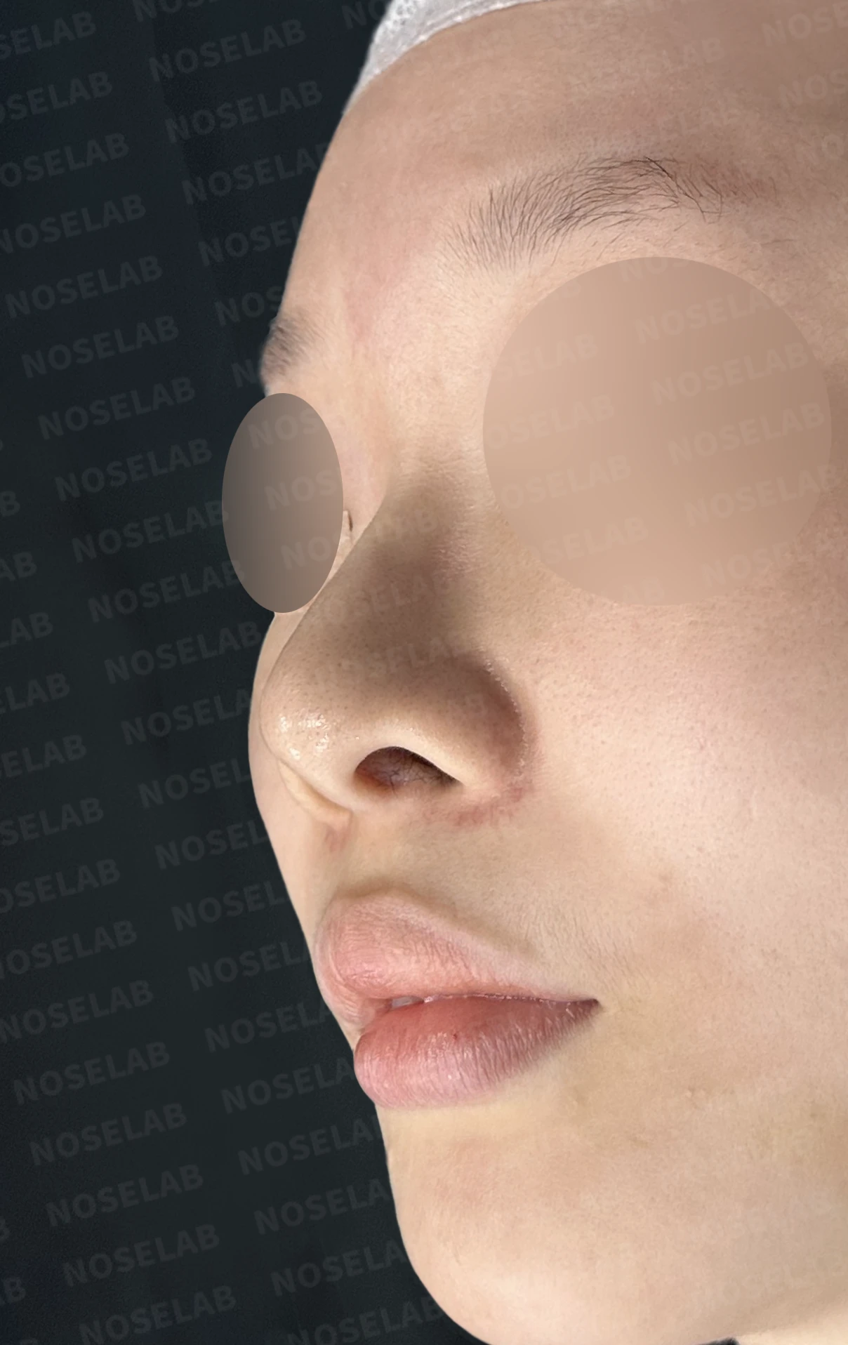절골 부위가 과하게 깎이면 코가 왜 휘어 보이는가, 코뼈 복원과 코끝 재건 — 수술 전 / 수술 직후 0일 직후 사진은 부기가 있는 상태로 최종 결과와 다를 수 있습니다.