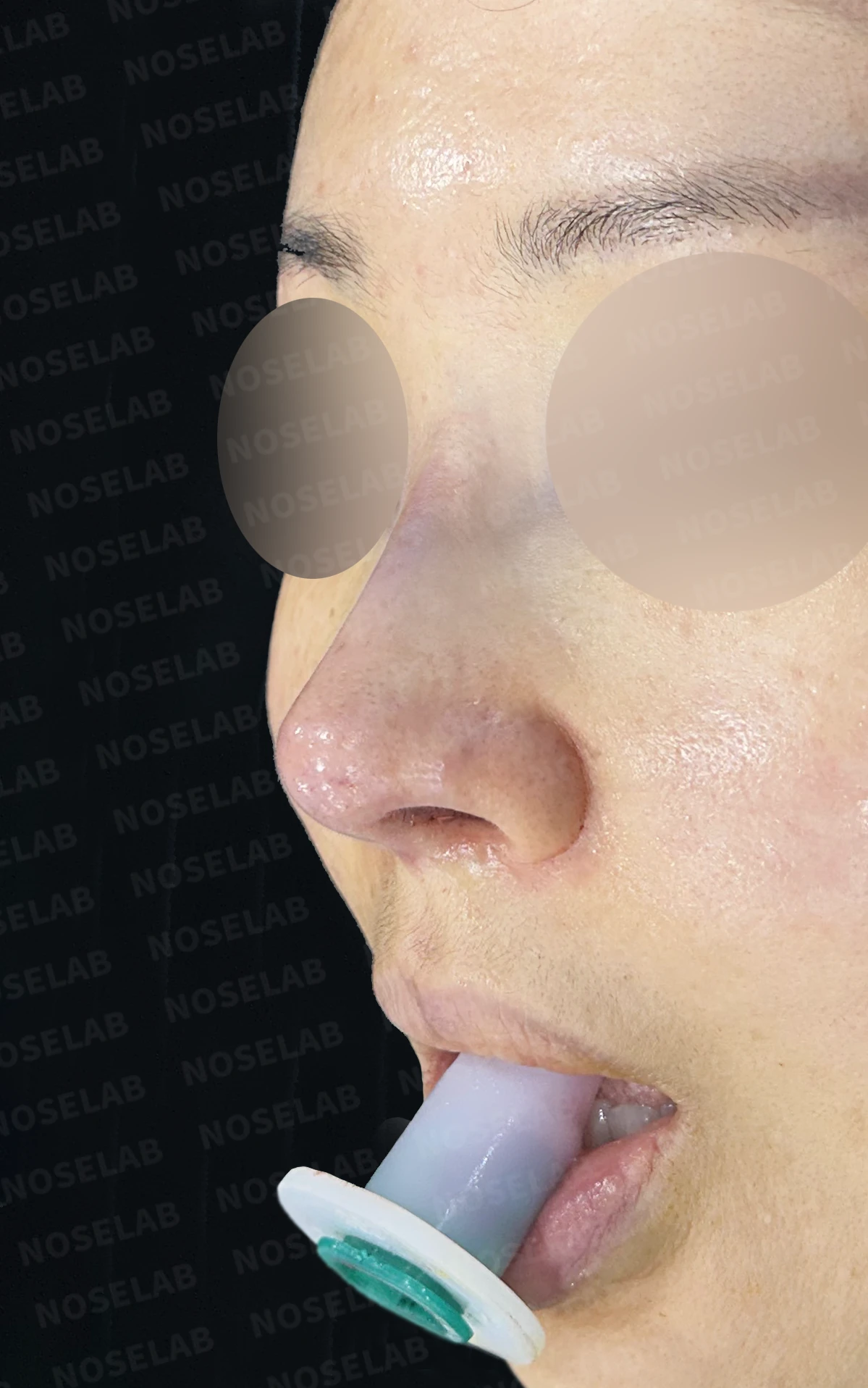 보형물 비침과 용코, 자가늑연골로 안전하게 교정한 코재수술 — 전(좌) 직후(후)
