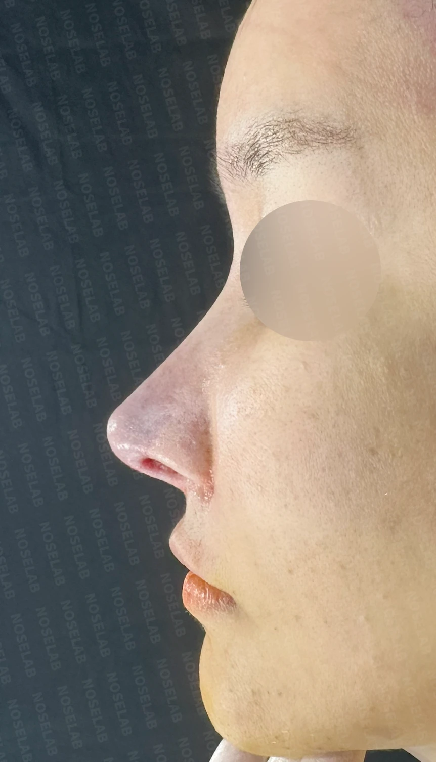 흡수된 기증늑연골을 자가늑연골로 교체 사례 — 전(좌) 직후(우)