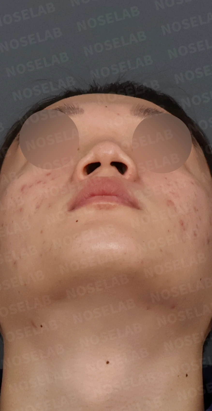 휜코 매부리코 교정, 남자 코성형으로 자연스러운 변화 — 디자인 상담 우측 측면, 비스듬한 측면, 비공 사진입니다.