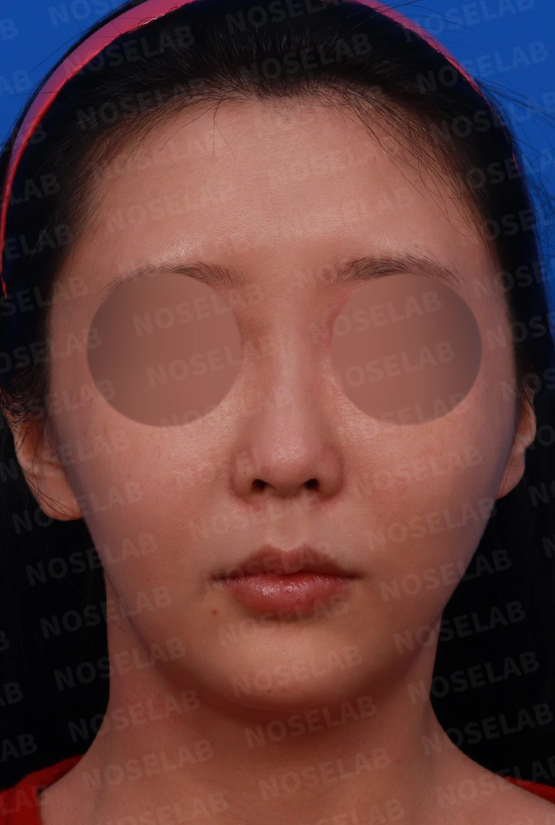 양악수술 뒤 코가 퍼지고 막히는 이유, 기능과 형태를 함께 보는 방법 — 디자인 상담 정면, 좌측 측면, 비스듬한 측면 사진입니다.