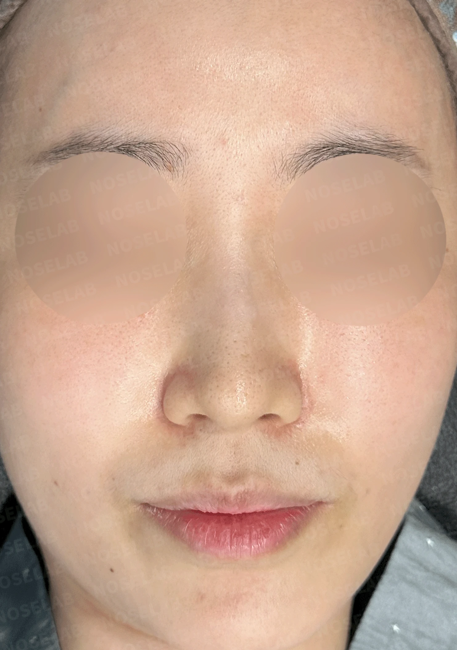 낮은 코의 지지 구조와 자가늑연골 교정 방법 — 본문 사진 7