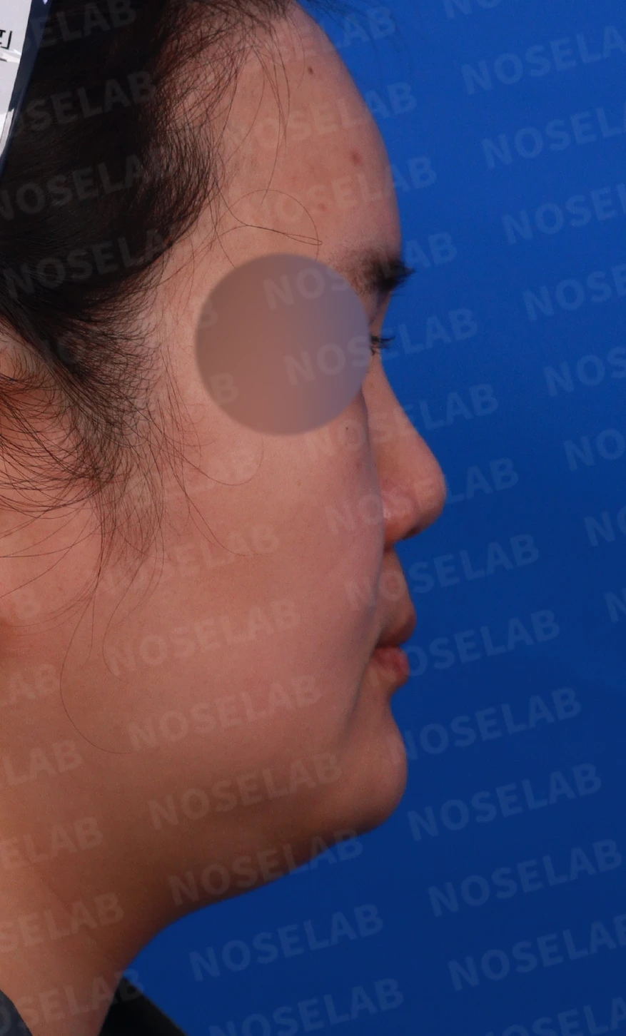 코에 삽입된 매선을 제거하고 재건하는 방법 — 디자인 상담 우측 측면, 비스듬한 측면, 비공 사진입니다.