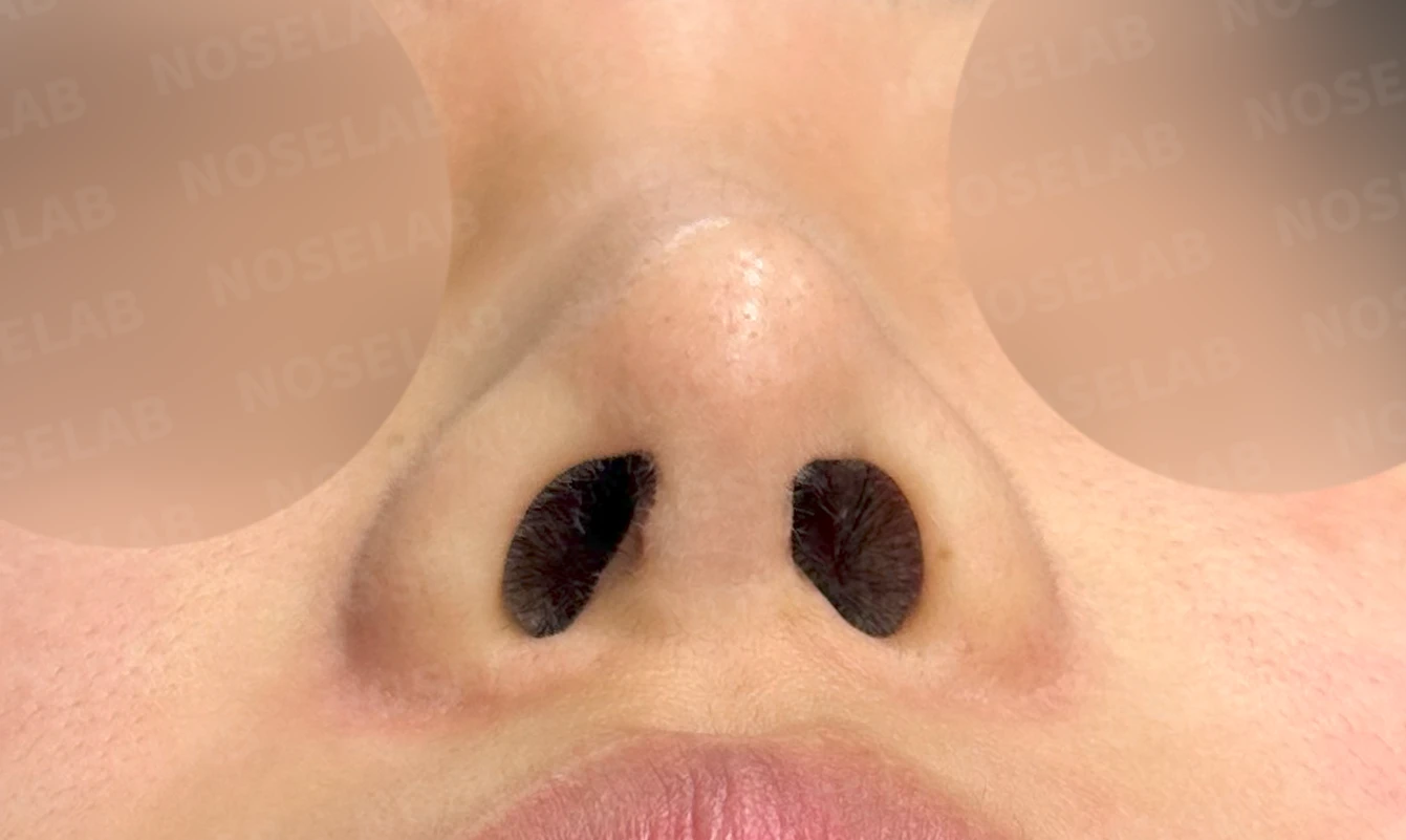 적절하지 않은 L자 실리콘 개선 - 안전한 구조로 재건 후기 — 전(좌) 직후(우)
