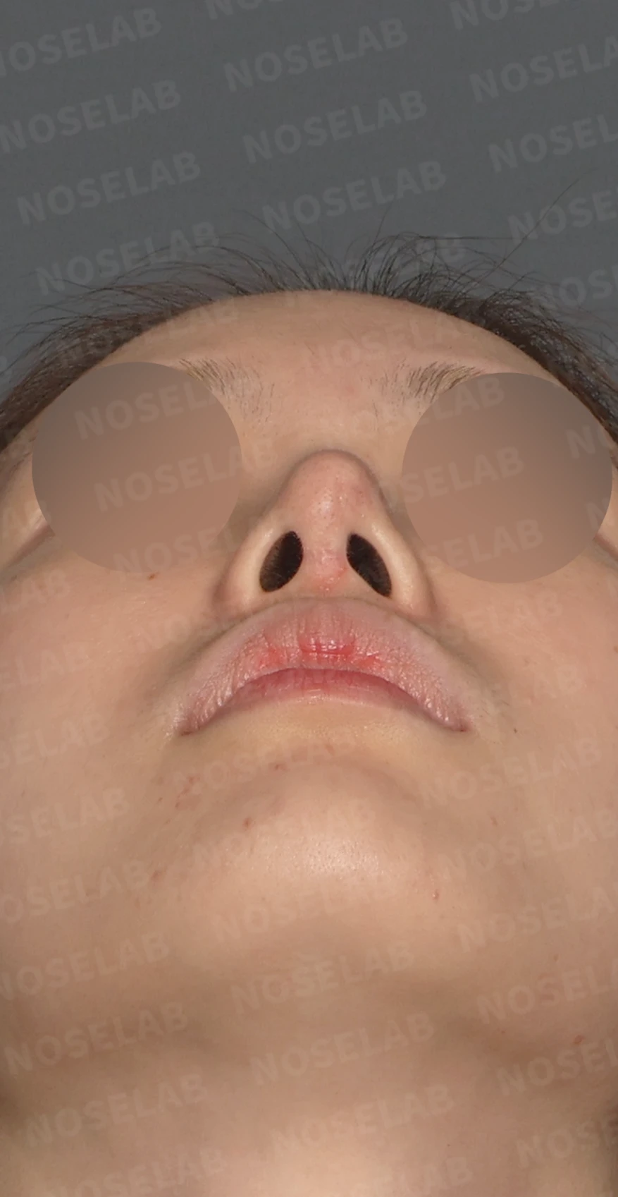 보형물 비침과 비대칭, 자가늑연골 코재수술로 자연스럽게 교정한 사례 — 디자인 상담 우측 측면, 비스듬한 측면, 비공 사진