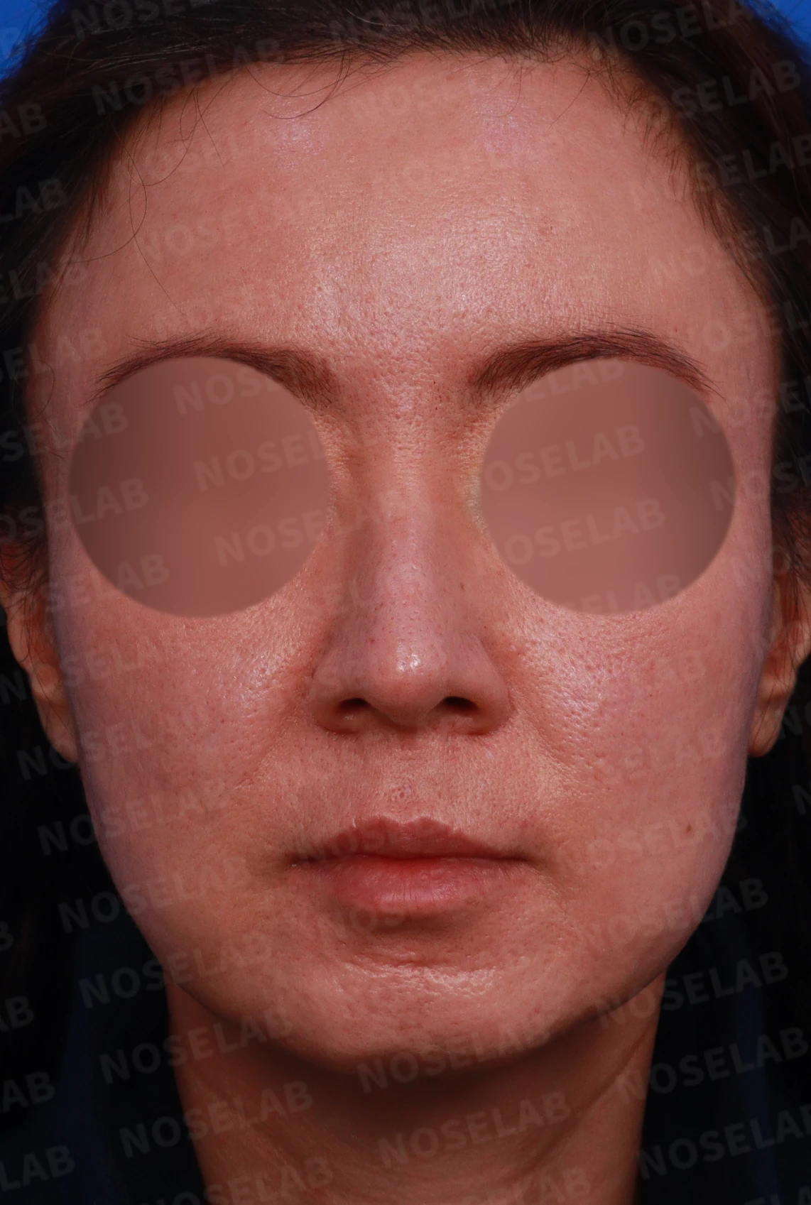 처진 코와 매부리코의 구조 및 교정 방법 — 디자인 상담 정면, 좌측 비스듬한 측면, 측면 사진
