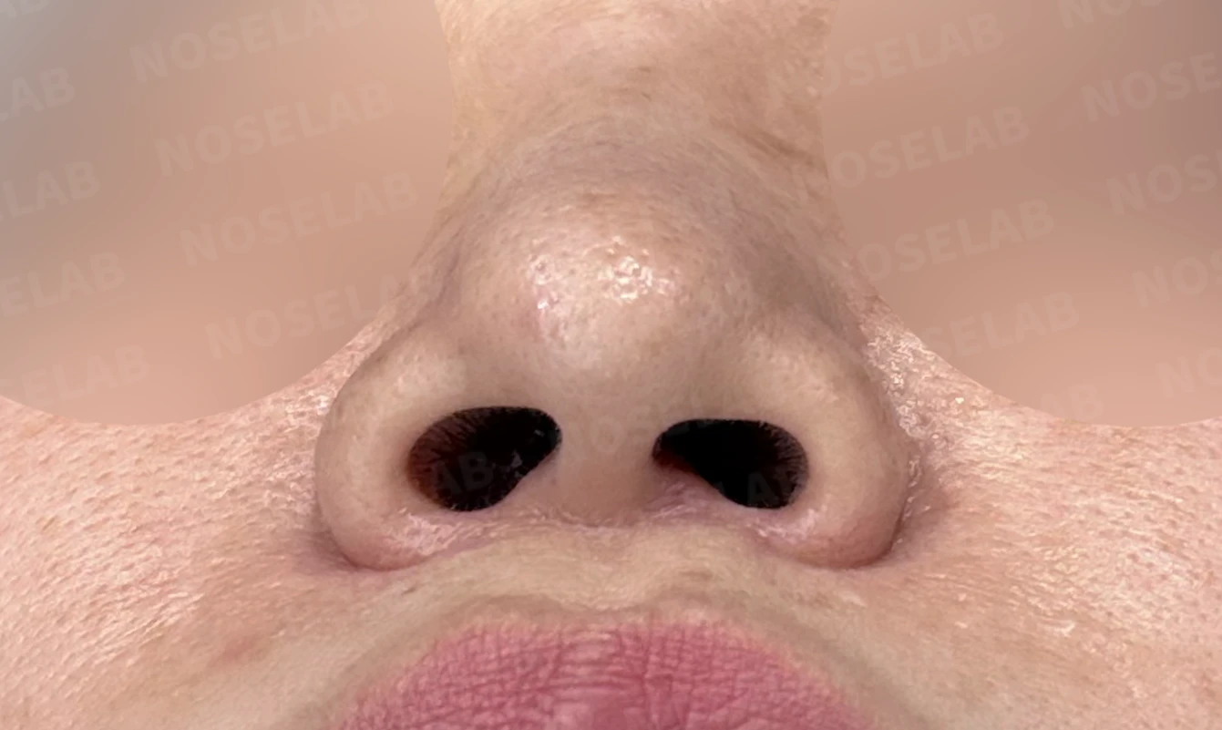 뭉툭하고 길게 처진 코가 중안면부를 길어 보이게 하는 이유, 석회화된 늑연골 재건 방법 — 수술 전 / 수술 직후 0일 직후 사진은 부기가 있는 상태로 최종 결과와 다를 수 있습니다.