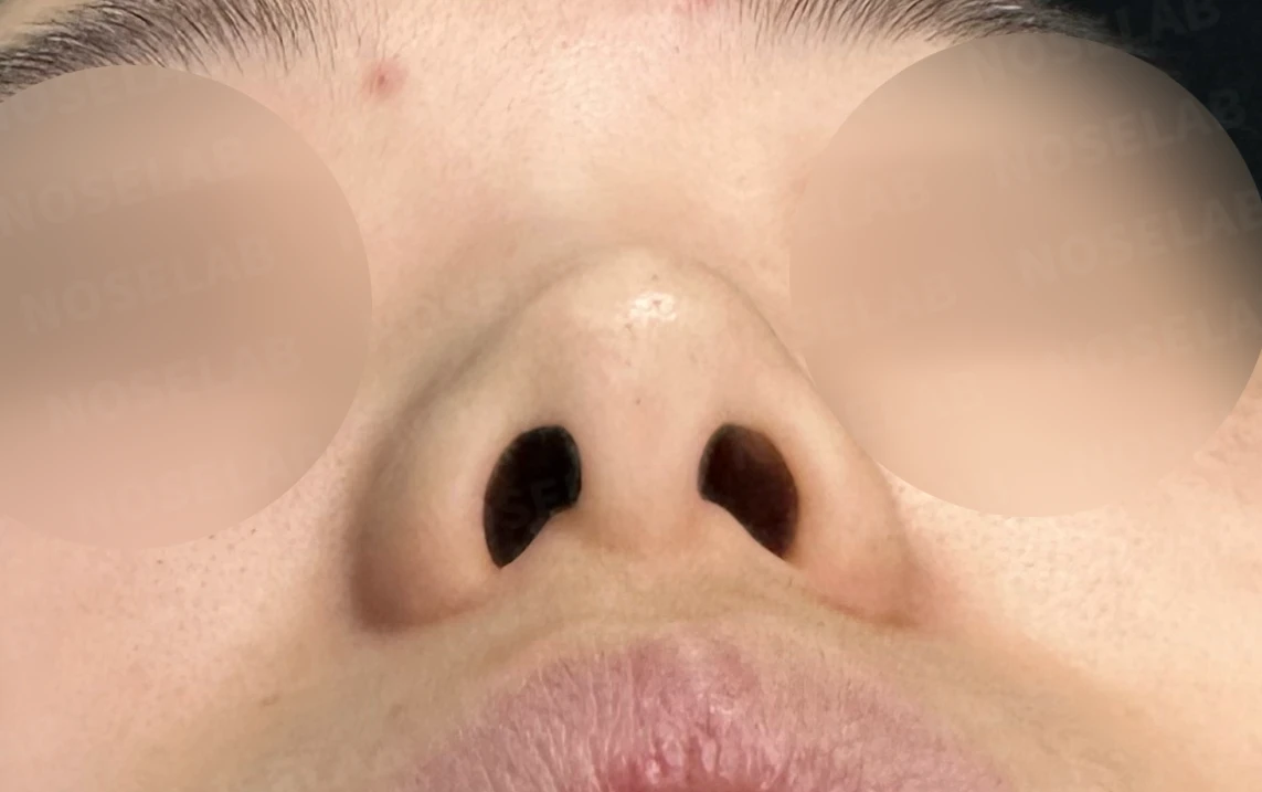 작고 짧은 들린 코 교정 방법 — 수술 전 / 수술 직후 0일 직후 사진은 부기가 있는 상태로 최종 결과와 다를 수 있습니다.