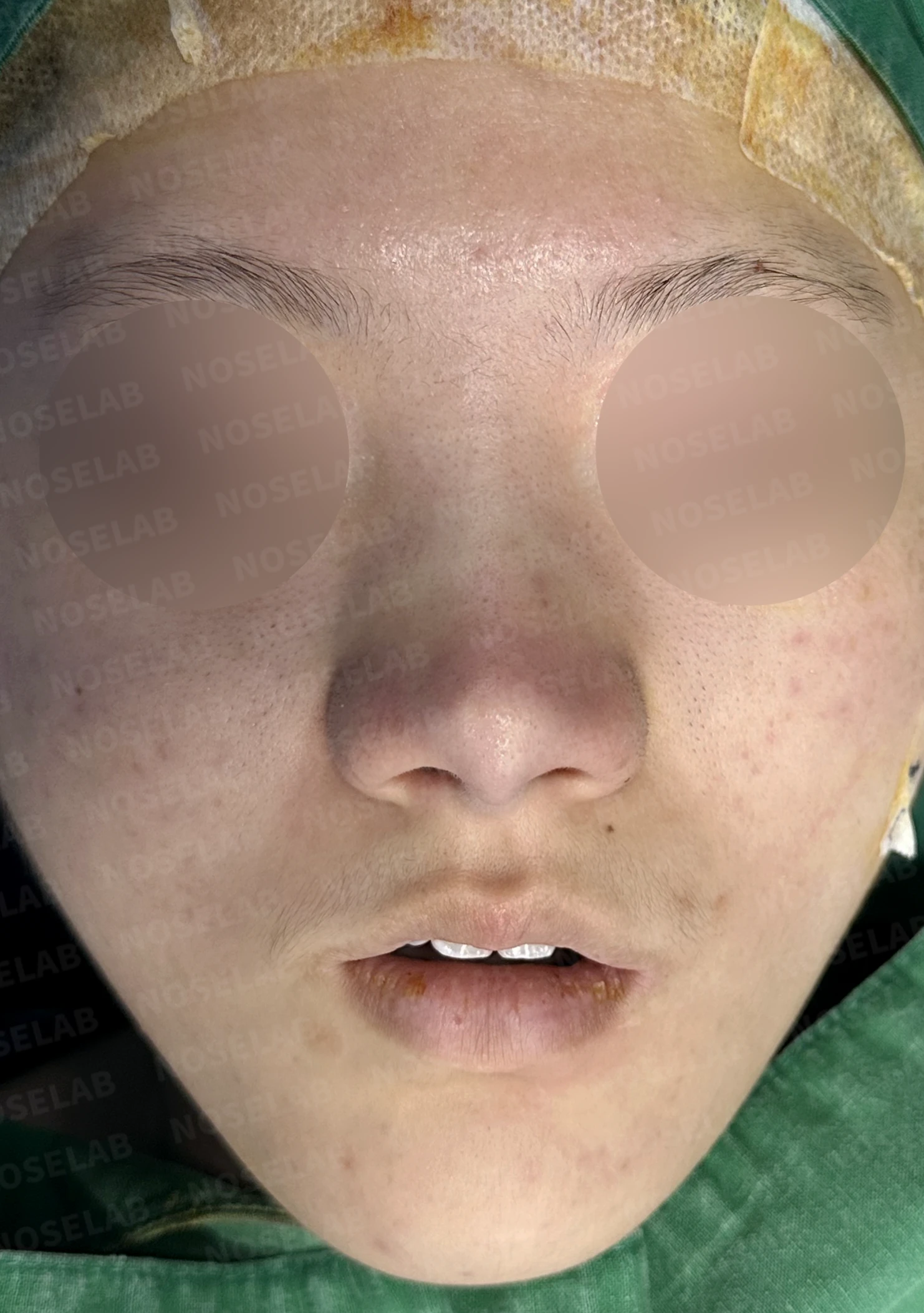 뭉툭한 코끝과 퍼진 코, 자가늑연골 비중격 연장술로 자연스럽게 교정 — 수술직후 정면, 비스듬한 측면, 측면 사진입니다.