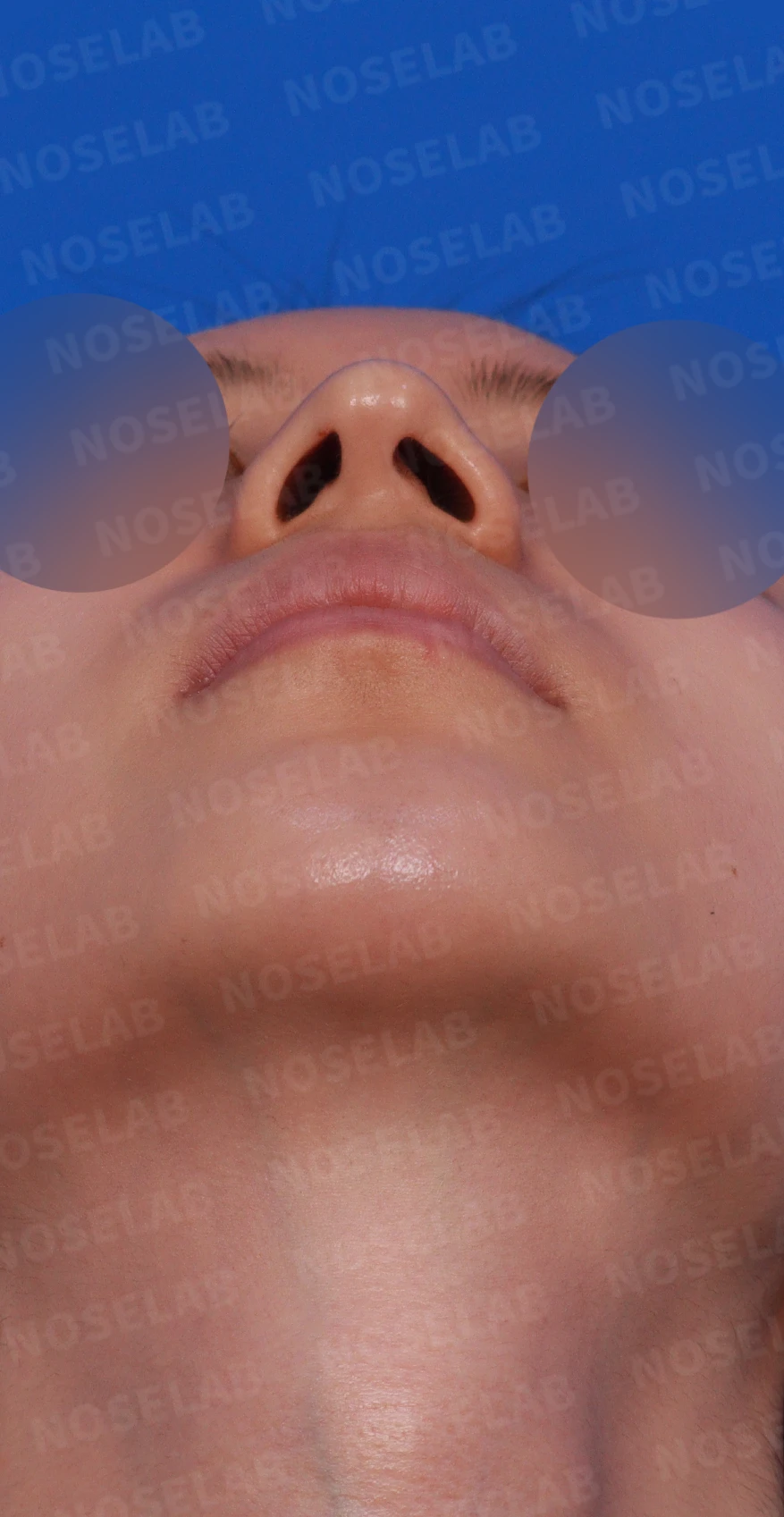 매부리코와 긴 코에 코막힘이 겹치는 이유, 교정은 어떻게 하나 — 디자인 상담 우측 비스듬한 측면, 측면, 비공 사진입니다.