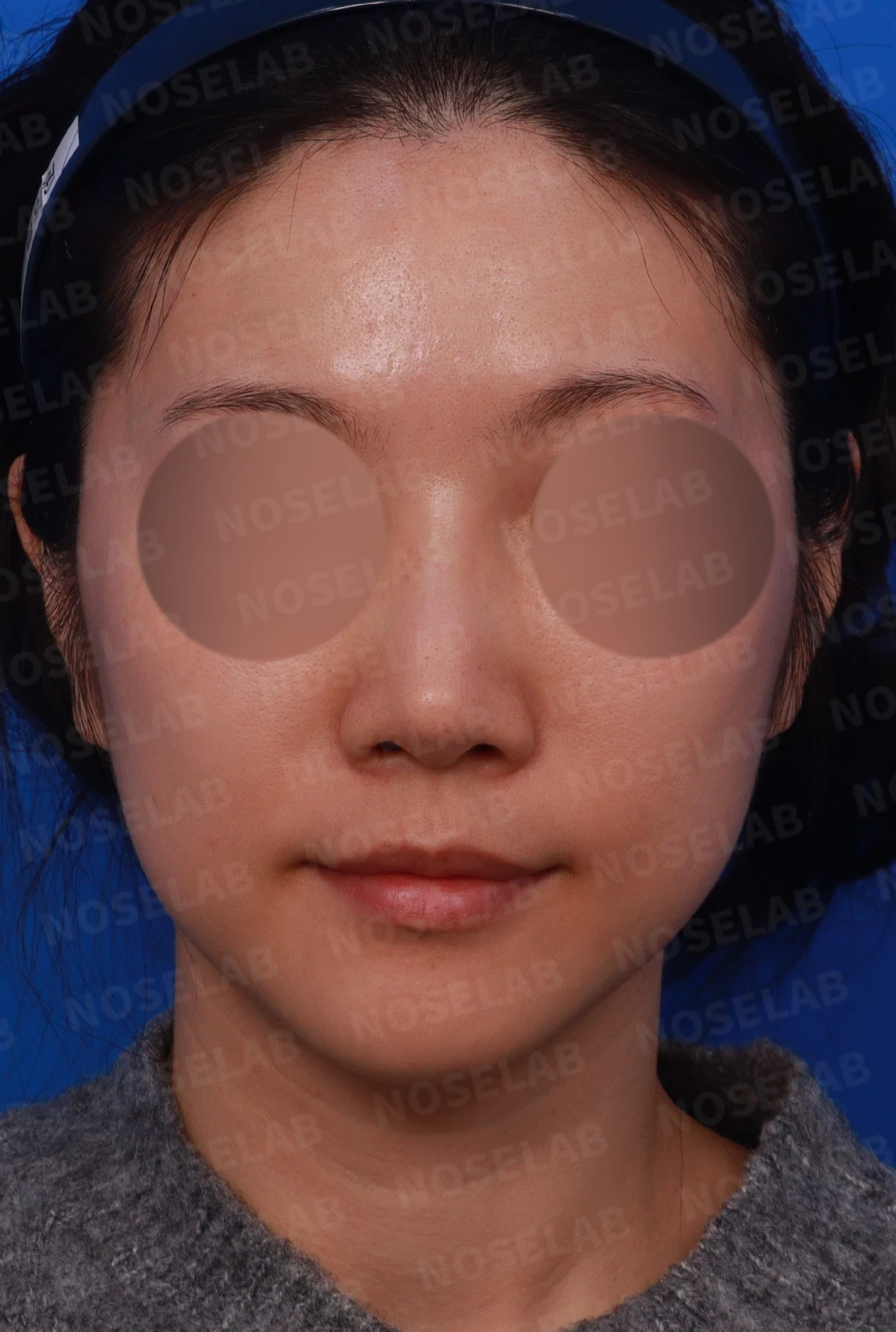 코끝과 콧대 비침 개선 - 자가늑연골, 진피이식 후기 — 디자인 상담 정면, 좌측 측면, 비스듬한 측면 사진
