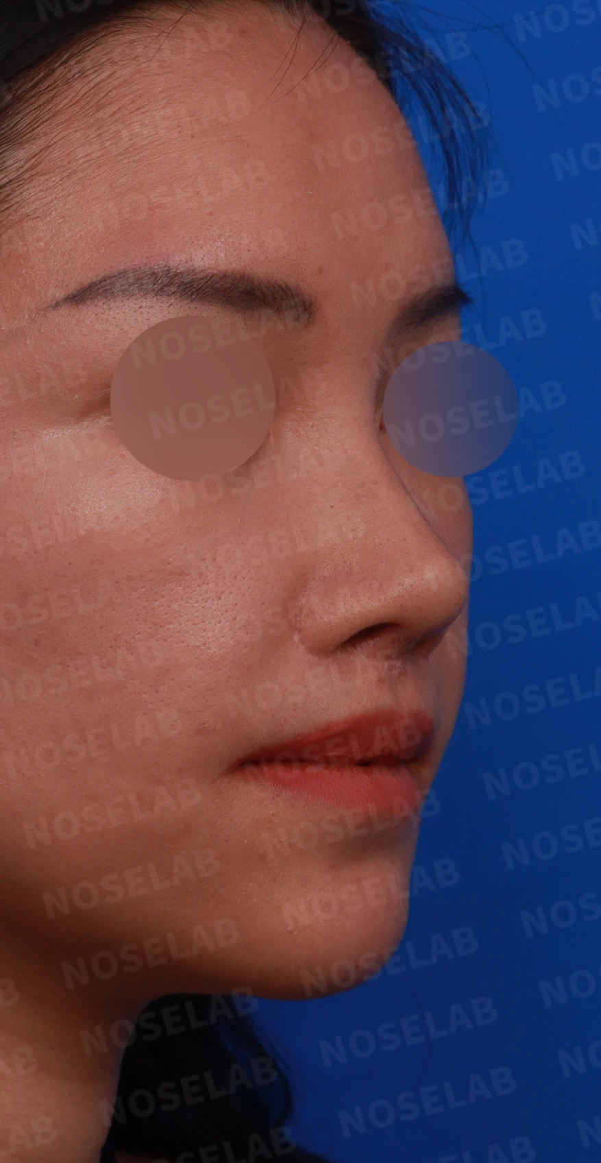 원하는 코 모양과 현재 구조를 함께 살펴보는 수술 계획 — 디자인 상담 우측 측면, 비스듬한 측면, 비공 사진입니다.