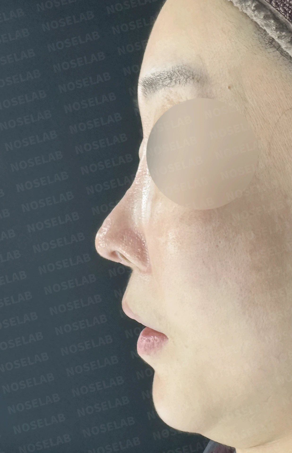 반복된 코재수술 뒤 안장코와 비밸브 협착이 생기는 이유, 전체 재건은 어떻게 하나 — 본문 사진 11