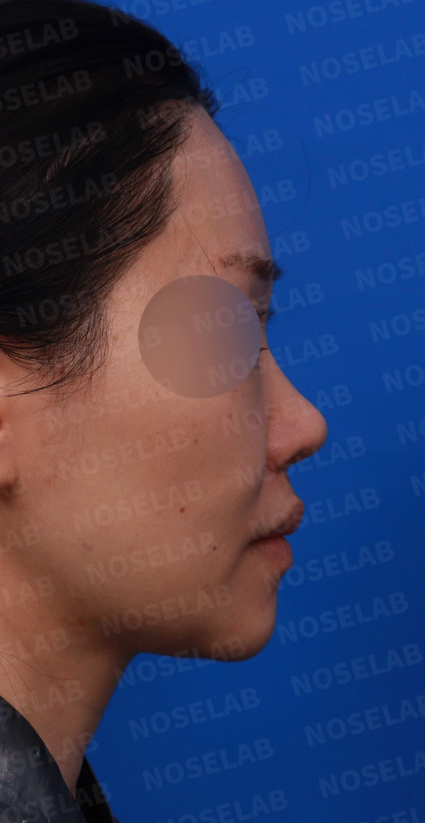 인공진피가 흡수되며 콧대가 낮아지고 퍼지는 이유 — 디자인 상담 우측 비스듬한 측면, 측면, 비공 사진입니다.
