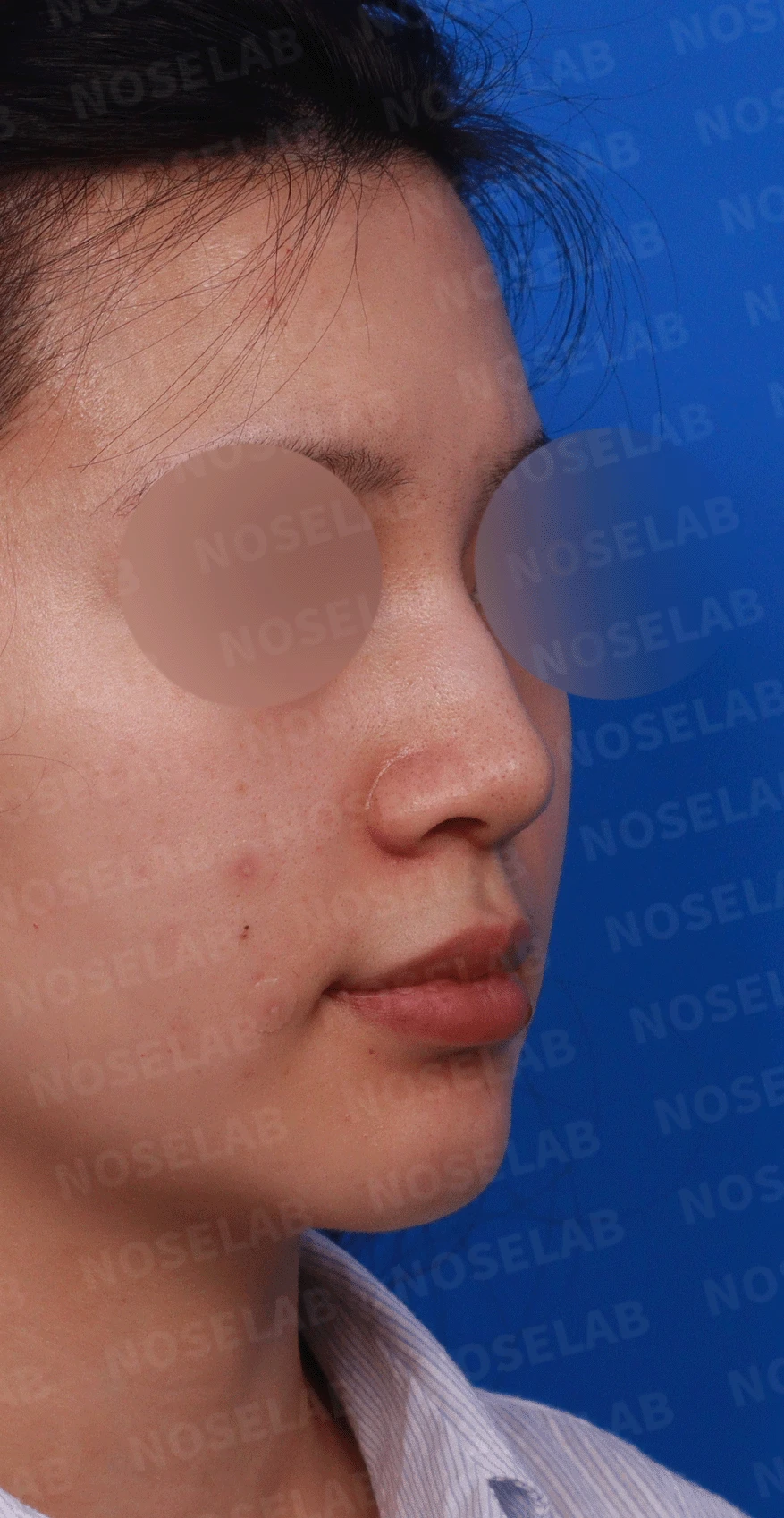 복코가 잘 교정되지 않는 이유와 이물질 제거 후 재건 방법 — 디자인 상담 우측 측면 , 비스듬한 측면 , 비공 사진