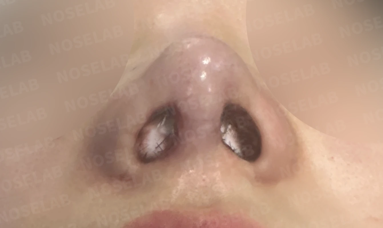 화살코와 복코가 함께 있는 코, 비중격 재건부터 시작하는 이유 — 수술 전 / 수술 직후 0일 직후 사진은 부기가 있는 상태로 최종 결과와 다를 수 있습니다.