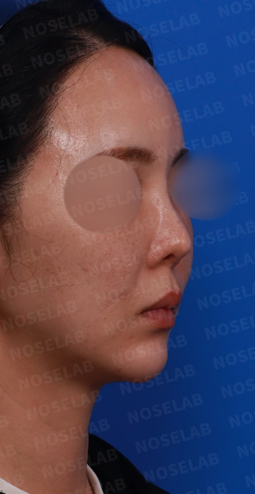 들린 코에서 콧구멍이 삼각형으로 드러나는 이유, 비공 모양 교정은 어떻게 하나 — 디자인 상담 우측 비스듬한 측면, 측면, 비공 사진