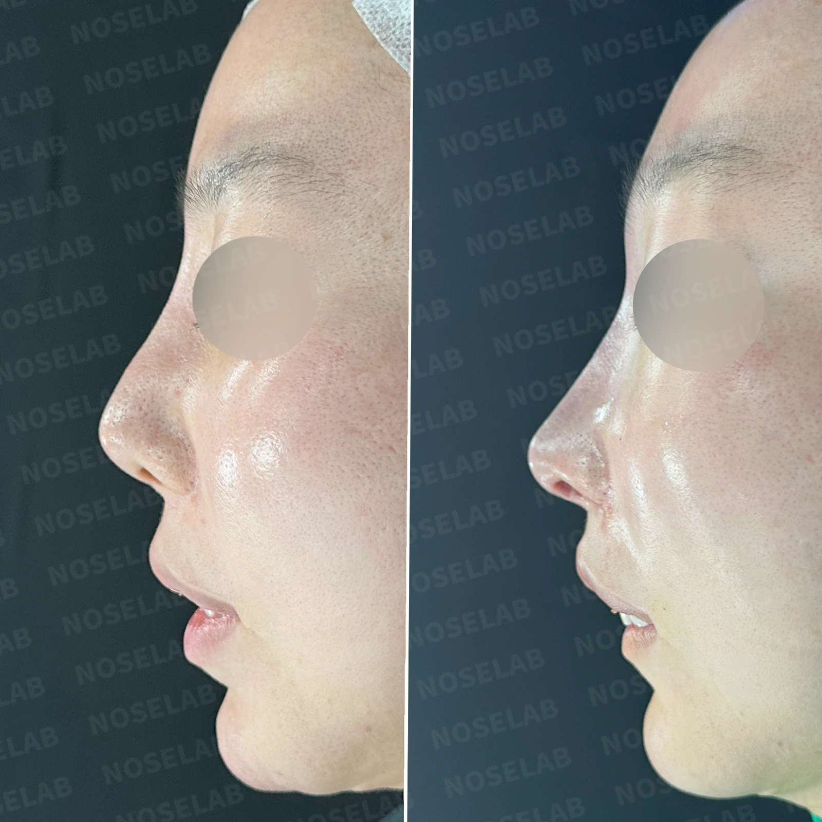 콧대가 뭉툭하게 퍼져 보이는 만성 이물 반응, 원인과 재건 방법 — 본문 사진 22