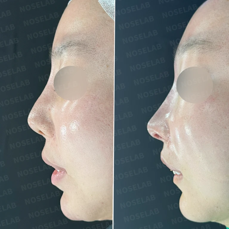 콧대 만성 이물반응과 양악 후 비중격 재건 - 자가늑연골 후기 — 전후 비교