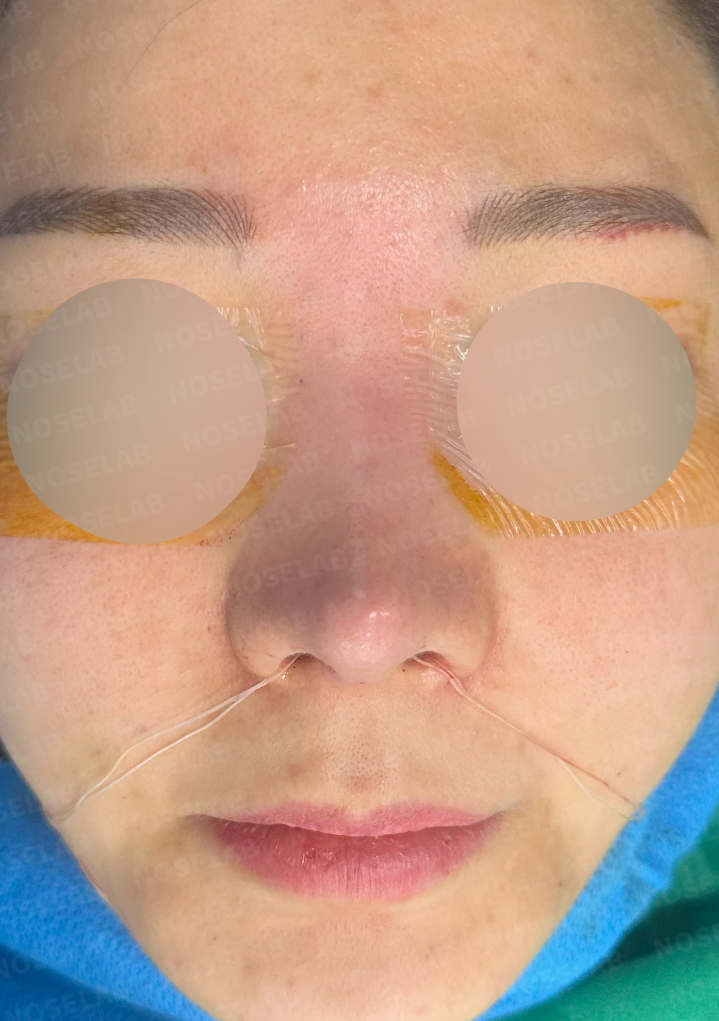 코가 휘어 보이고 비주가 한쪽으로 기우는 이유, 교정은 어떻게 하나 — 수술 전 / 수술 직후 0일 직후 사진은 부기가 있는 상태로 최종 결과와 다를 수 있습니다.