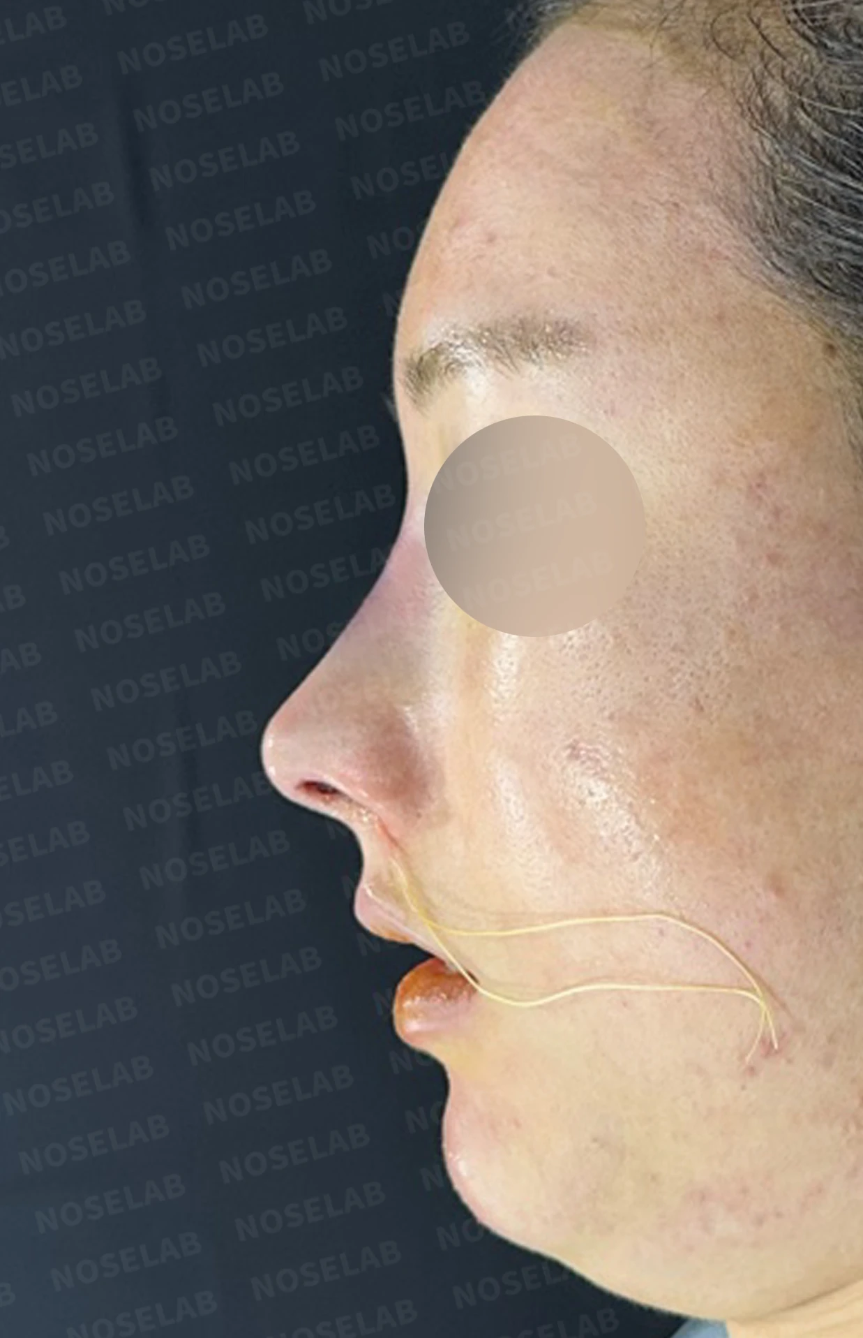 코 필러 뒤에도 휜 코와 코막힘이 남는 이유, 교정은 어떻게 하나 — 수술 전 / 수술 직후 0일 직후 사진은 부기가 있는 상태로 최종 결과와 다를 수 있습니다.