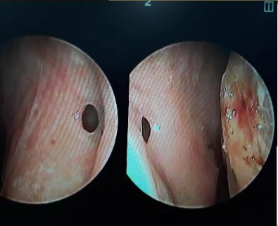 14년간 7차례 수술 후 비중격천공과 복잡한 코끝 문제 해결 - 자가늑연골 재건 실제 후기 — 코내시경 사진