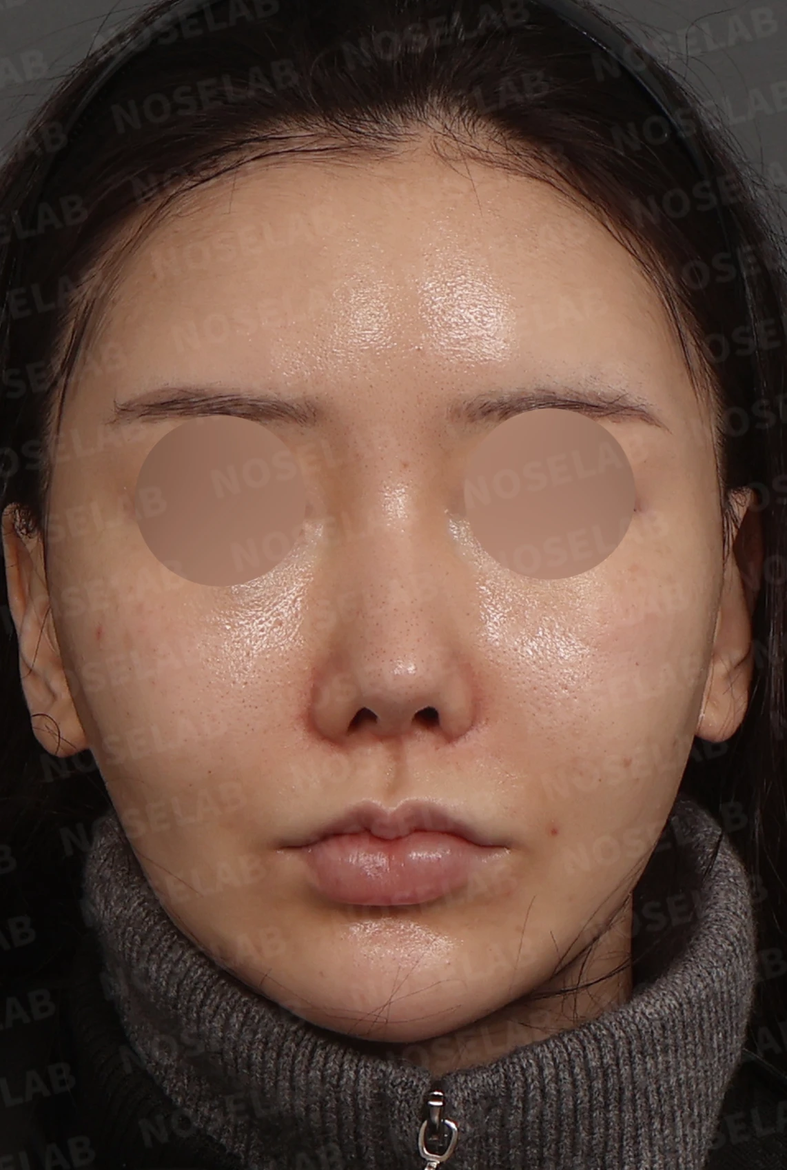 휘어진 코와 비공 비대칭, 자가늑연골 비중격 재건으로 완성한 코재수술 — 디자인 상담 정면, 좌측 측면, 비스듬한 측면 사진
