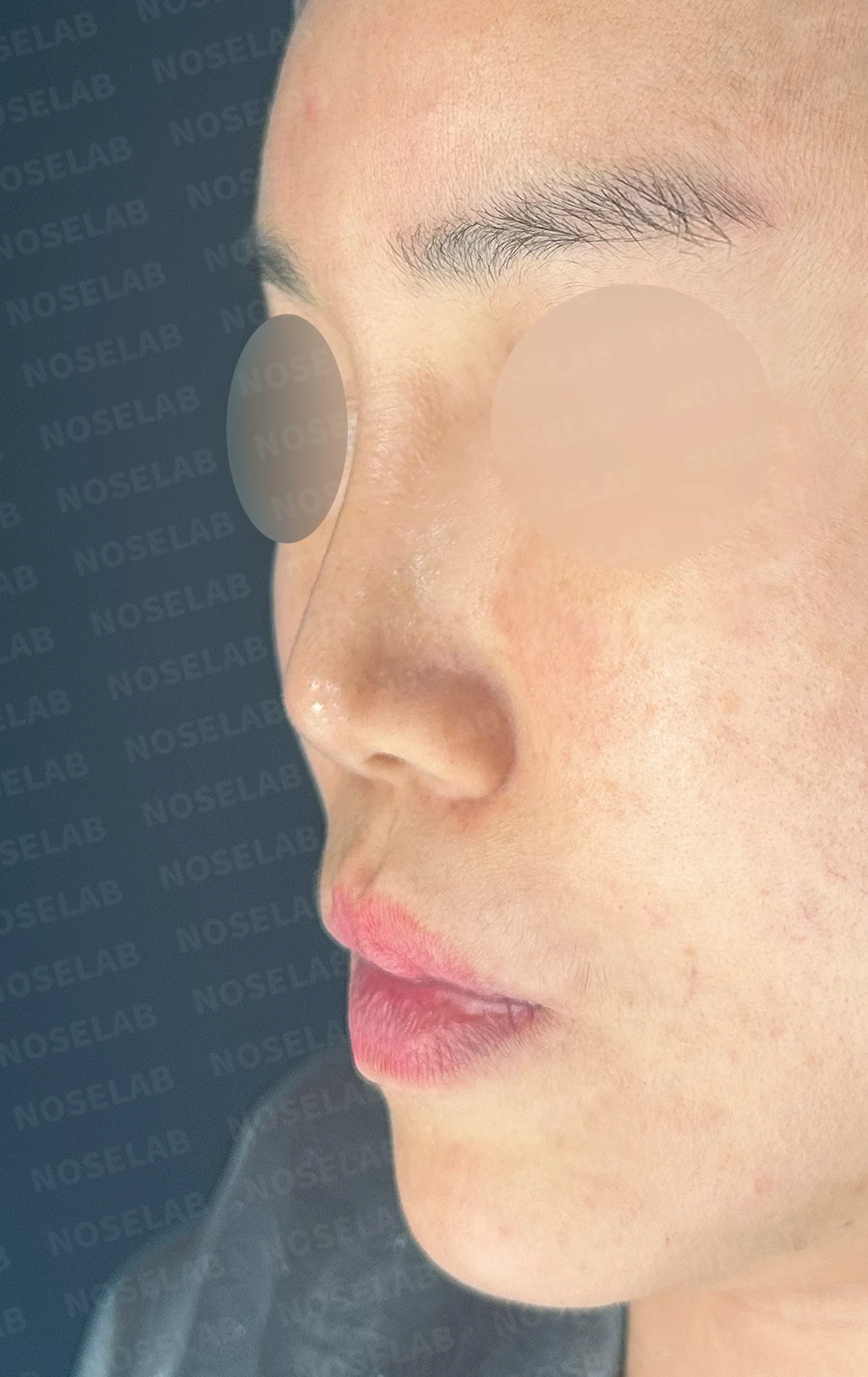 메드포어를 넣은 코에 코막힘이 생기는 이유, 제거와 자가늑연골 비중격 재건은 어떻게 하나 — 수술 전 / 수술 직후 0일 직후 사진은 부기가 있는 상태로 최종 결과와 다를 수 있습니다.