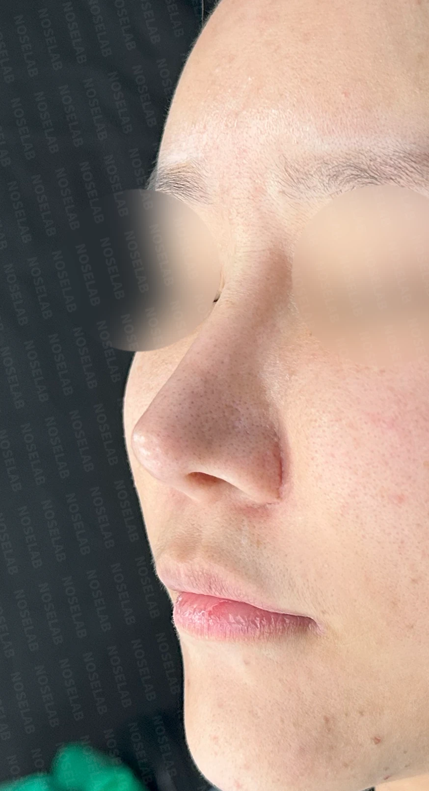 흡수된 기증늑연골을 자가늑연골로 교체 사례 — 전(좌) 직후(우)