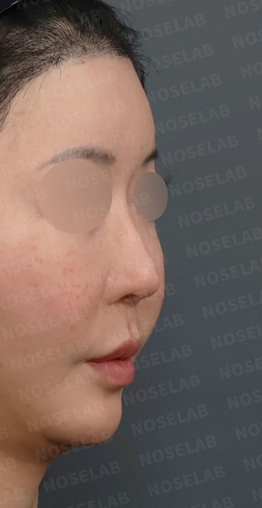 코성형 뒤 코막힘이 더 심해지는 이유, 비중격 재건과 절골 복원은 어떻게 하나 — 디자인 상담 우측 측면, 비스듬한 측면, 비공 사진입니다.