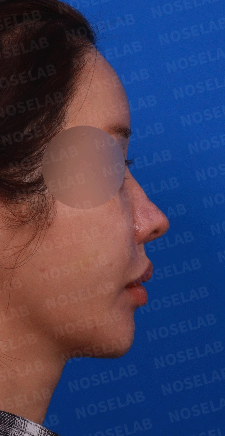 코 수술 뒤 콧등 피부가 괴사하면 어떤 변화가 남고, 재건은 어떻게 하나 — 디자인 상담 정면 , 비스듬한 측면 사진, 우측 측면